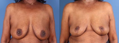 Breast Lift Before & After Gallery - Patient 962623 - Image 1