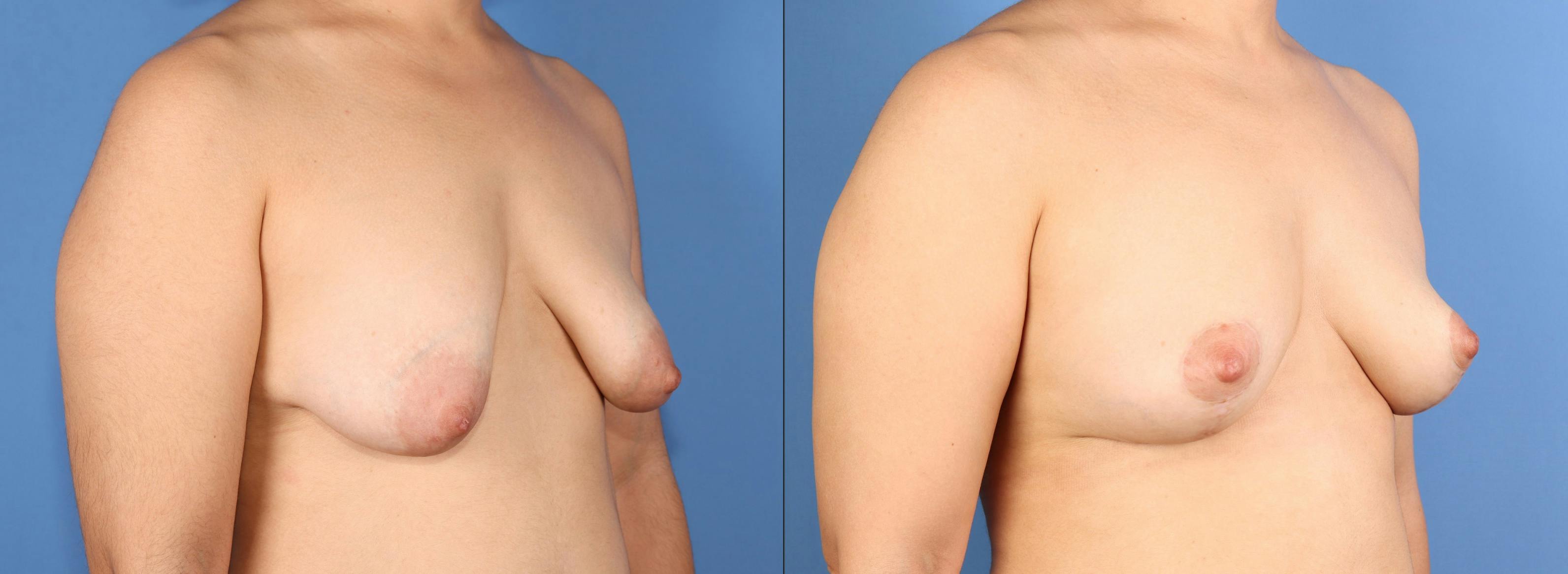 Correction of Tuberous Breast Before & After Gallery - Patient 378635 - Image 2