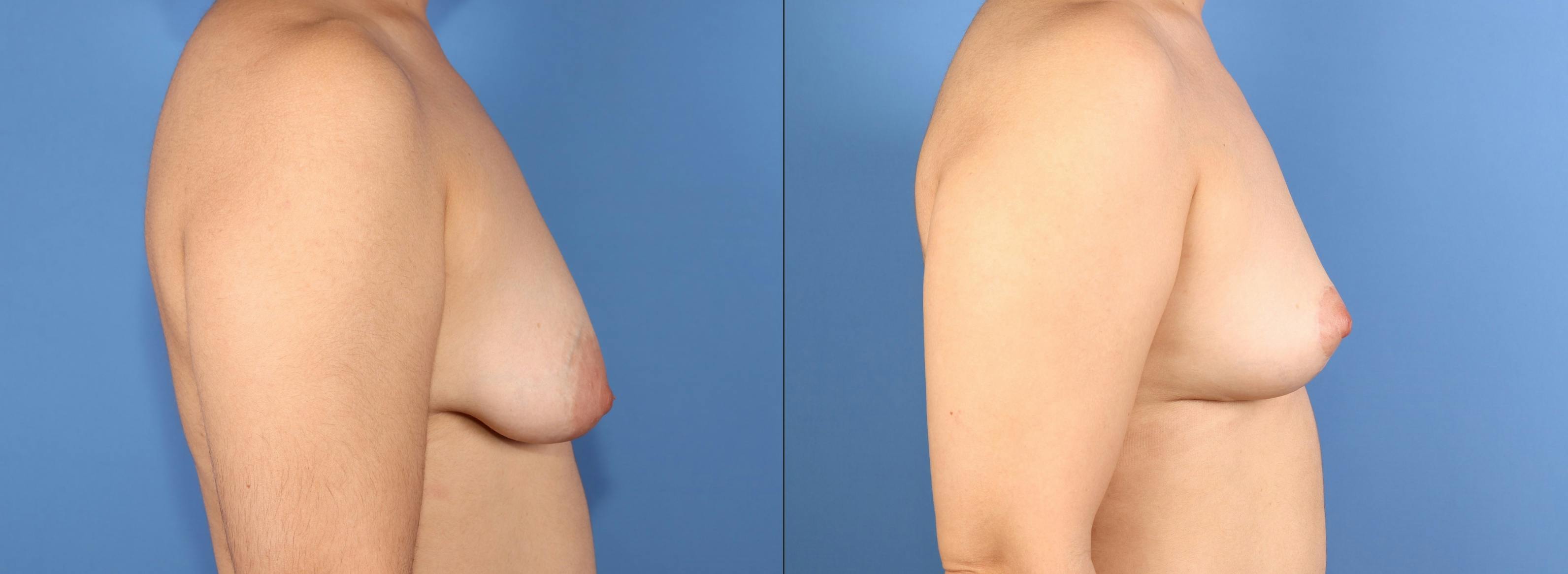 Correction of Tuberous Breast Before & After Gallery - Patient 378635 - Image 3