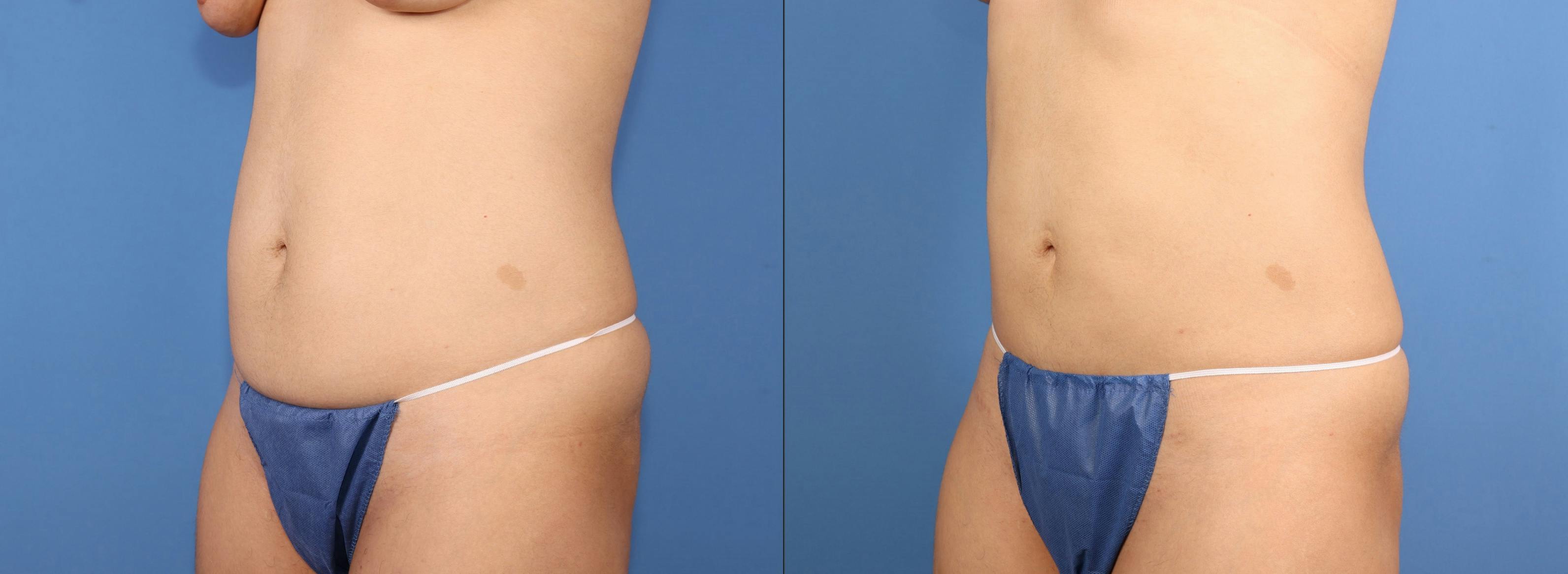 Abdomen Before & After Gallery - Patient 991647 - Image 2
