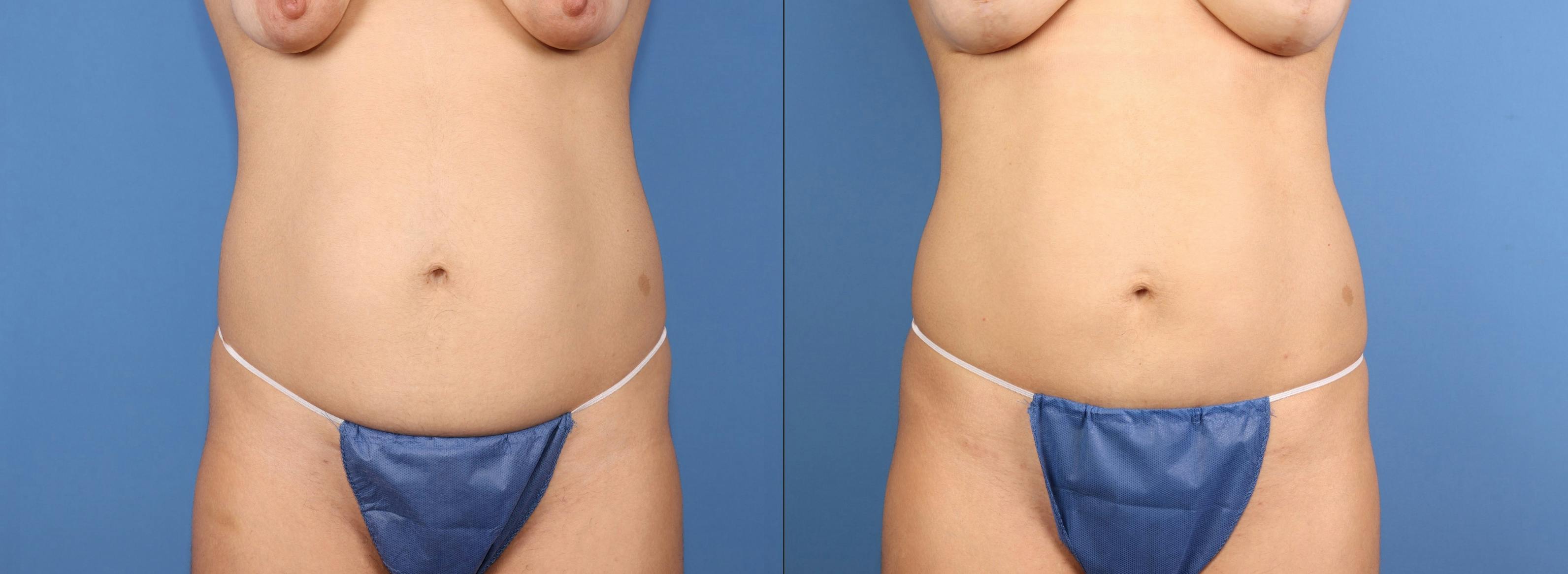 Abdomen Before & After Gallery - Patient 991647 - Image 1