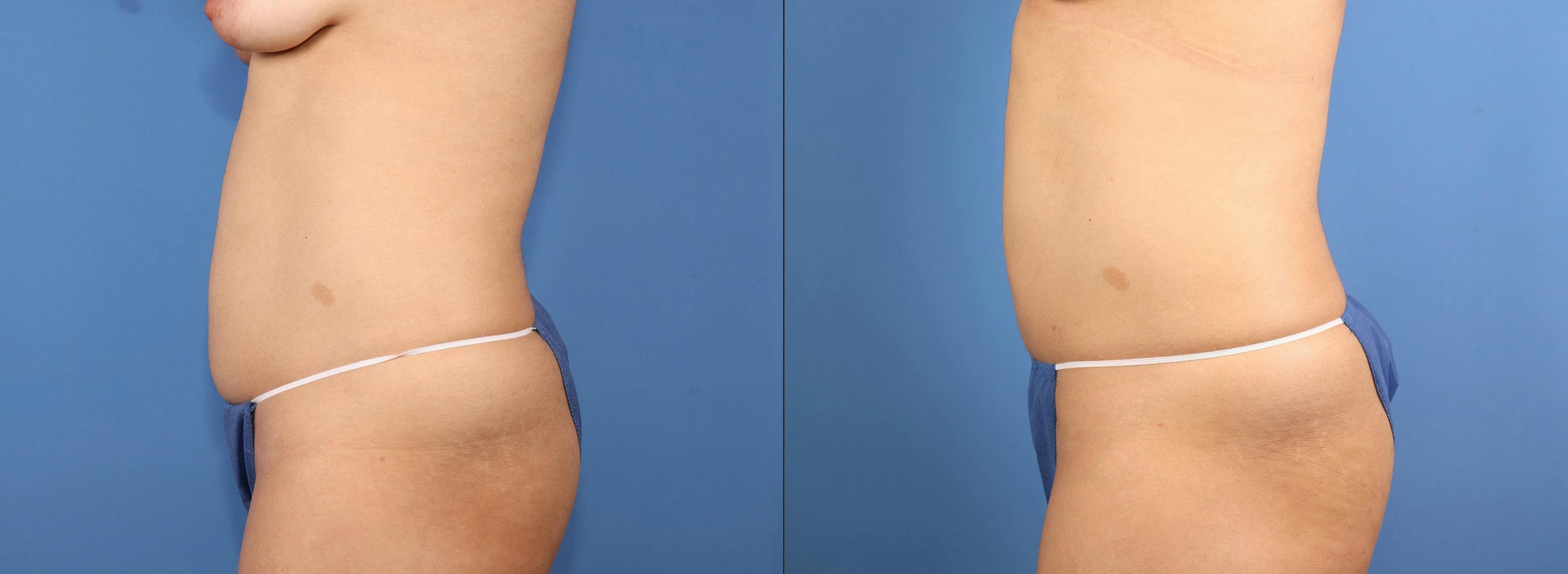 Abdomen Before & After Gallery - Patient 991647 - Image 3