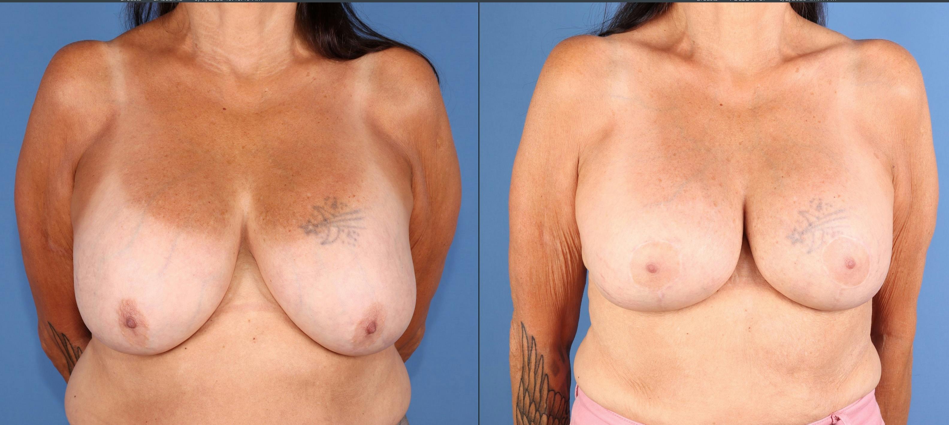 Breast Lift Before & After Gallery - Patient 289626 - Image 1