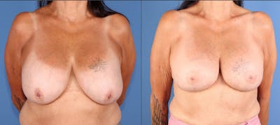 Breast Lift Before & After Gallery - Patient 289626 - Image 1