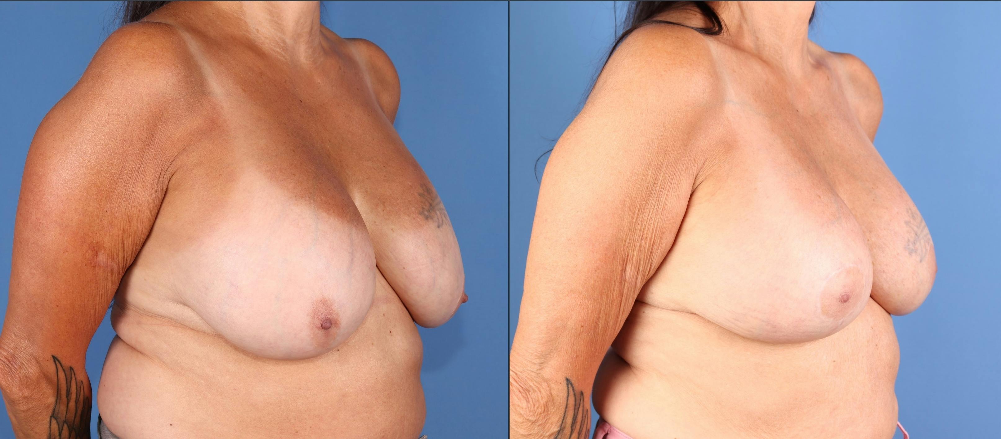 Breast Lift Before & After Gallery - Patient 289626 - Image 2