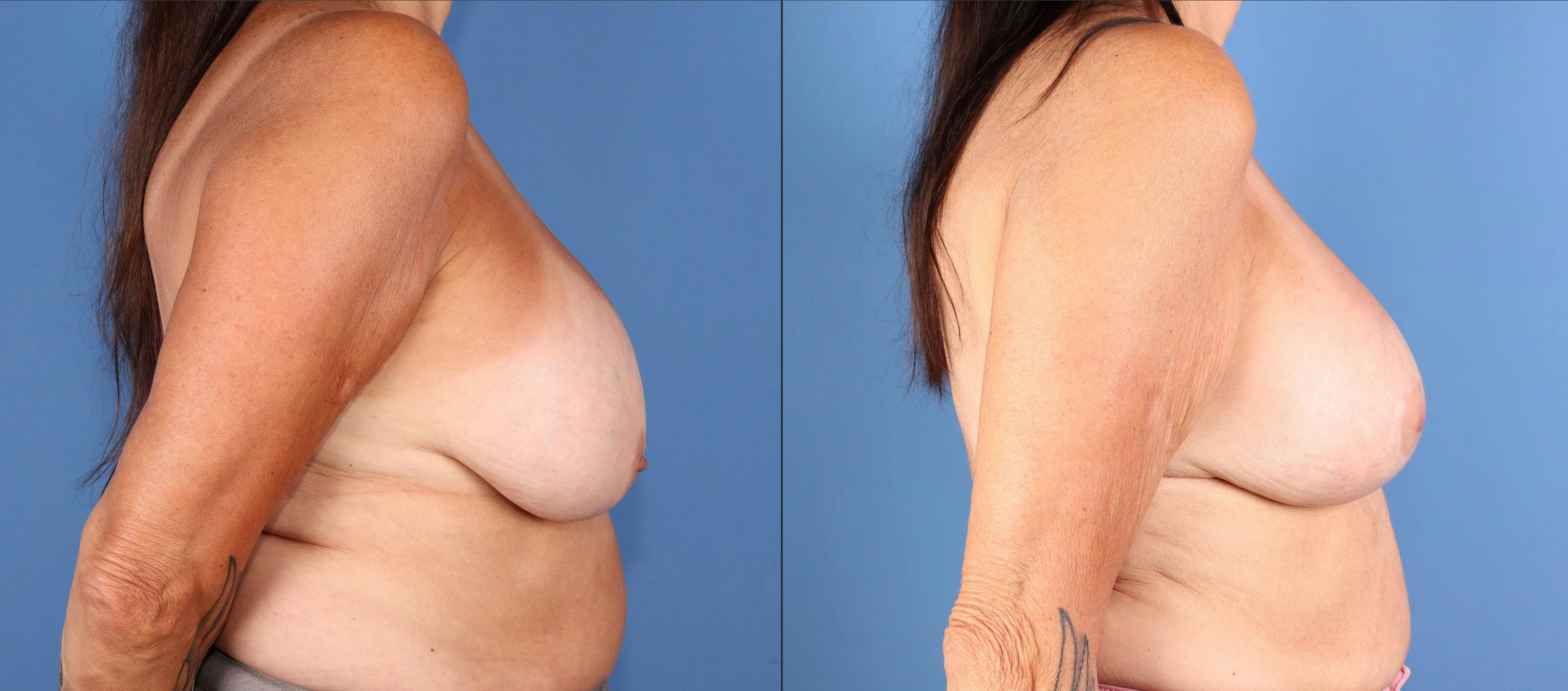 Breast Lift Before & After Gallery - Patient 289626 - Image 3