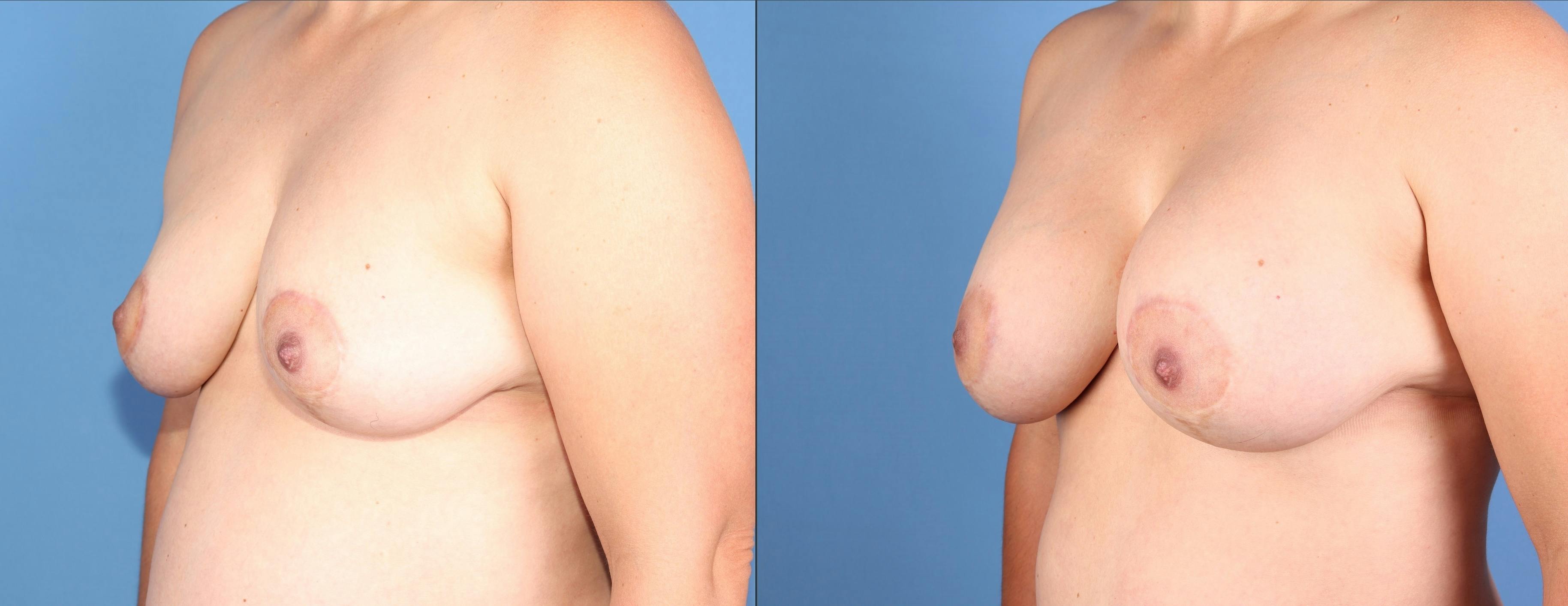 Breast Lift with Augmentation Before & After Gallery - Patient 261244 - Image 2