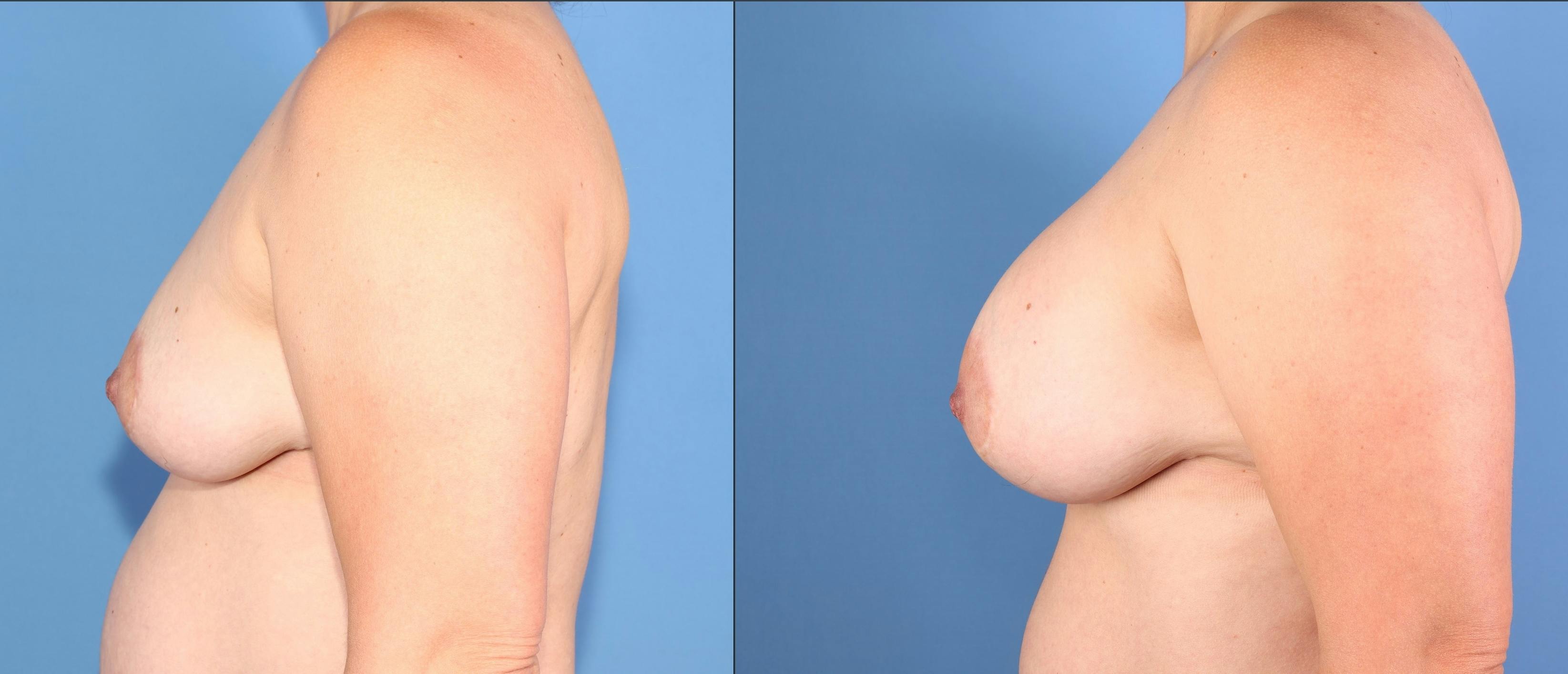 Breast Lift with Augmentation Before & After Gallery - Patient 261244 - Image 3