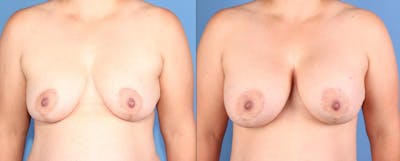Breast Lift with Augmentation Before & After Gallery - Patient 261244 - Image 1