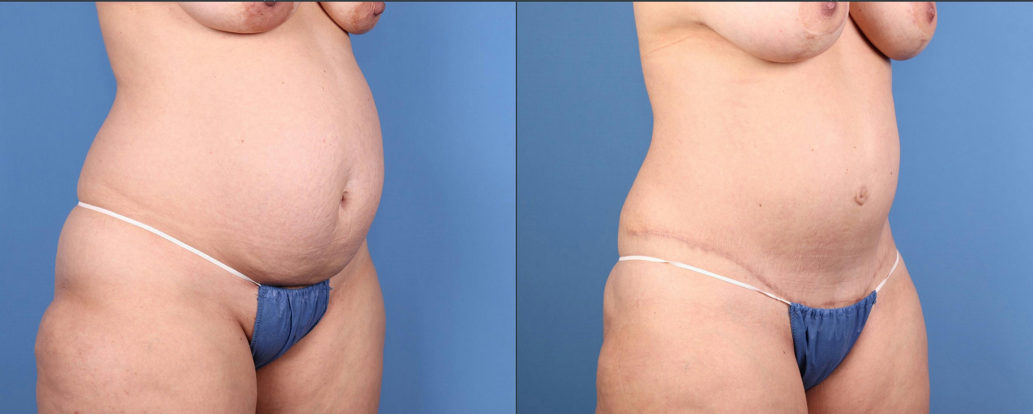 Tummy Tuck Before & After Gallery - Patient 201735 - Image 2