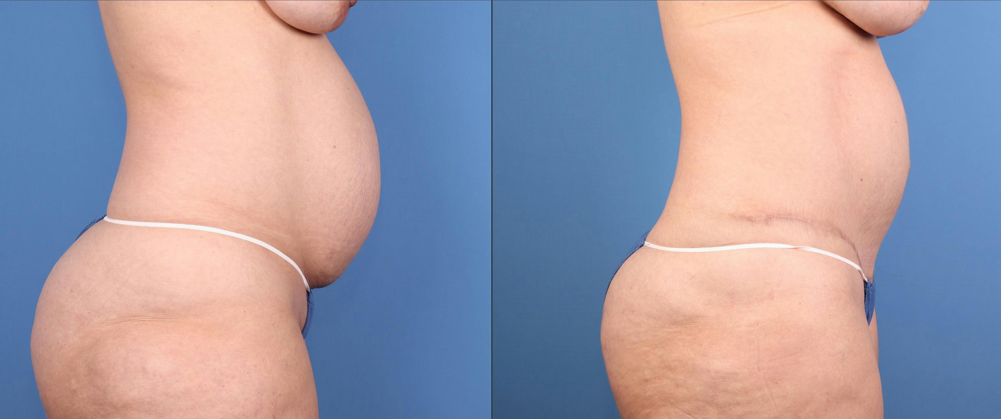Tummy Tuck Before & After Gallery - Patient 201735 - Image 3