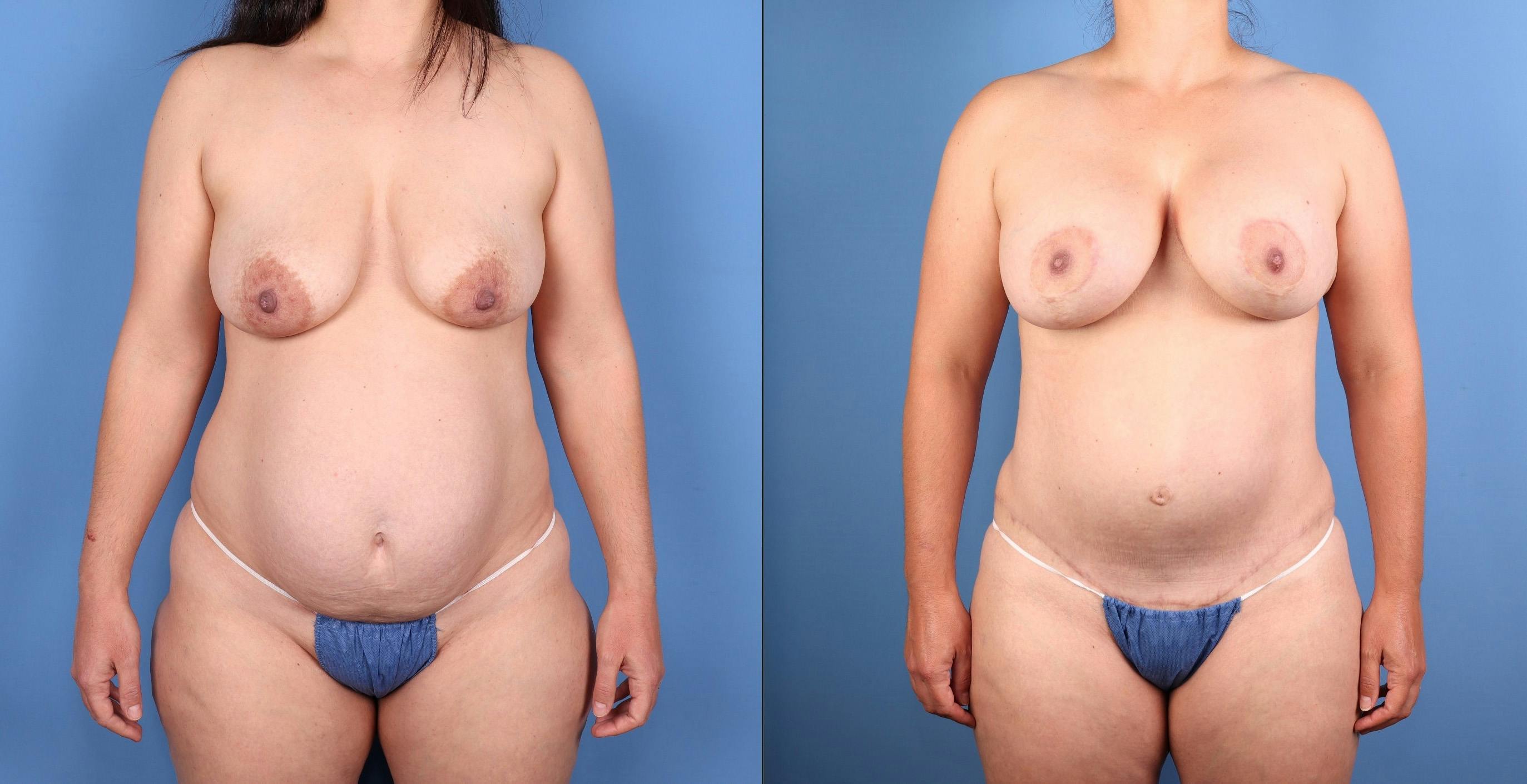 Tummy Tuck Before & After Gallery - Patient 201735 - Image 4