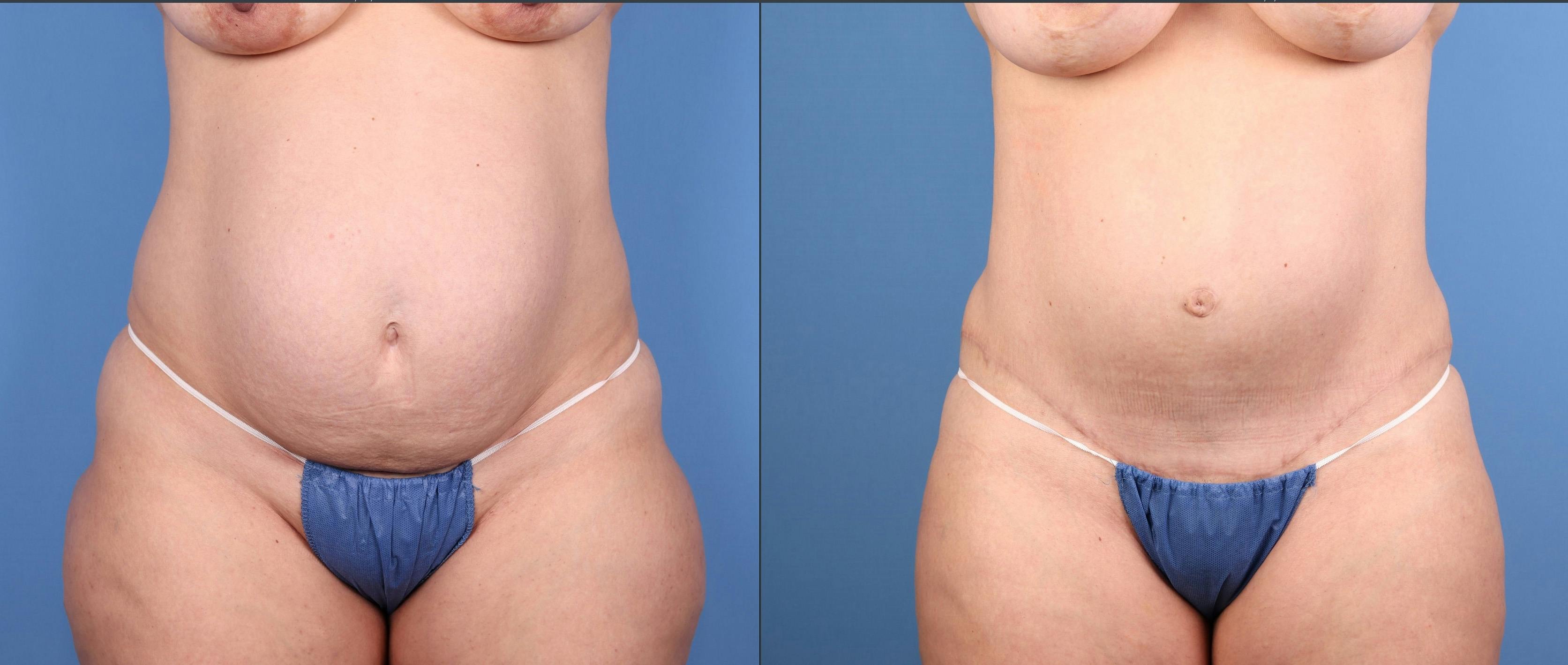 Tummy Tuck Before & After Gallery - Patient 201735 - Image 1