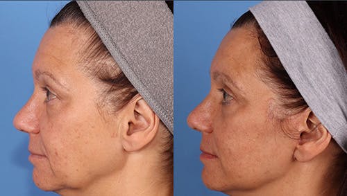 Brow Lift Before & After Gallery - Patient 281067 - Image 5