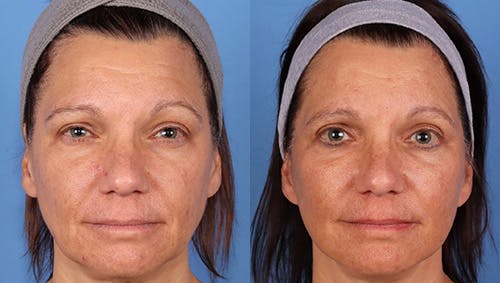Brow Lift Before & After Gallery - Patient 281067 - Image 1