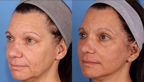 Brow Lift Before & After Gallery - Patient 281067 - Image 4
