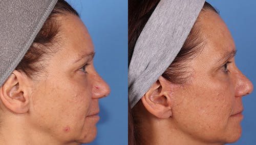 Brow Lift Before & After Gallery - Patient 281067 - Image 3