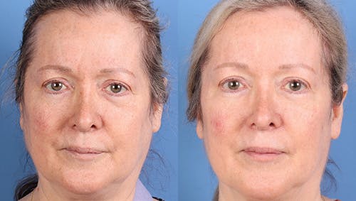 Brow Lift Before & After Gallery - Patient 179400 - Image 1