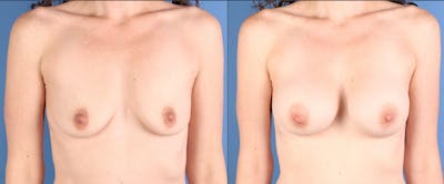 Breast Augmentation Before & After Gallery - Patient 121977 - Image 1