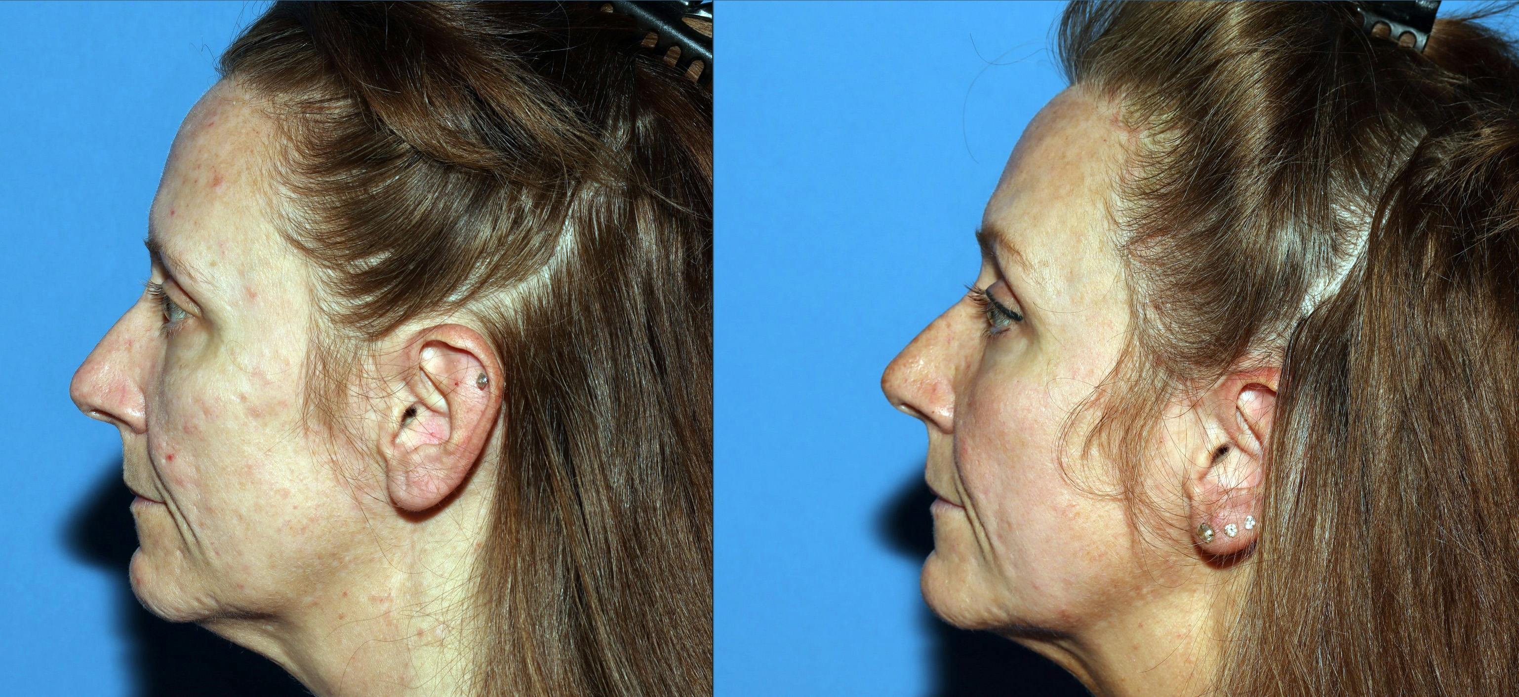 Contour TRL Laser Before & After Gallery - Patient 882108 - Image 5