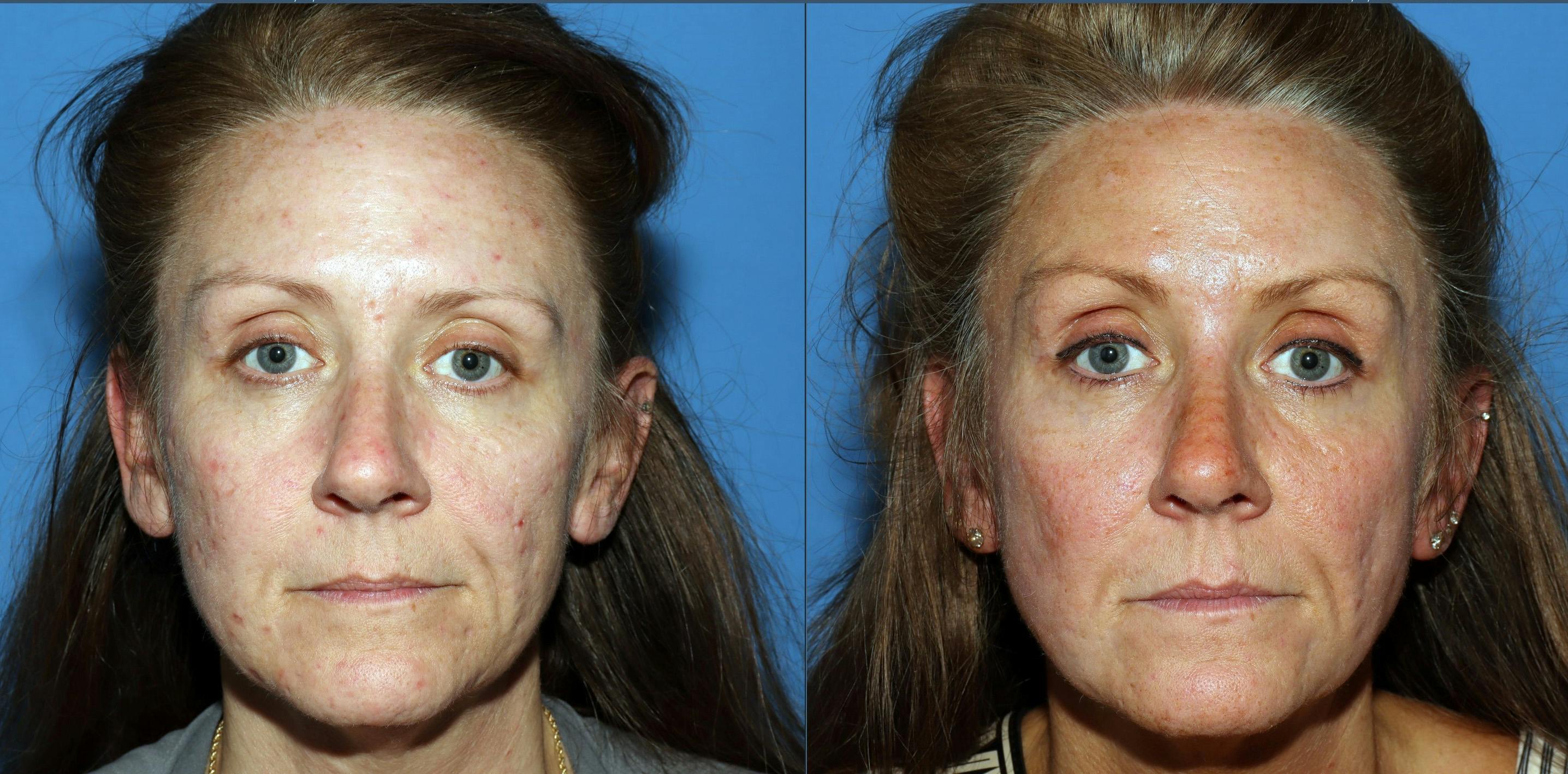 Contour TRL Laser Before & After Gallery - Patient 882108 - Image 1