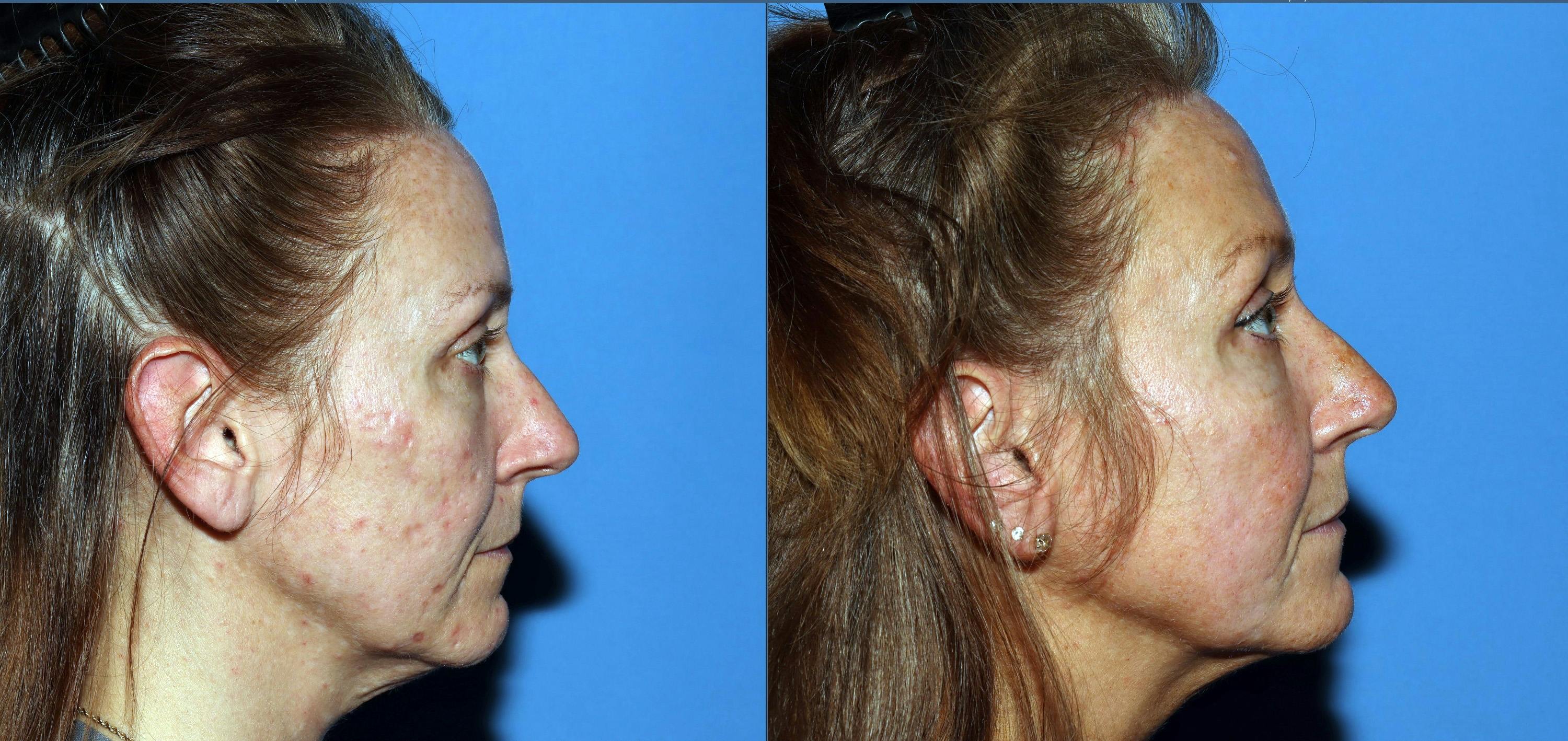 Contour TRL Laser Before & After Gallery - Patient 882108 - Image 3