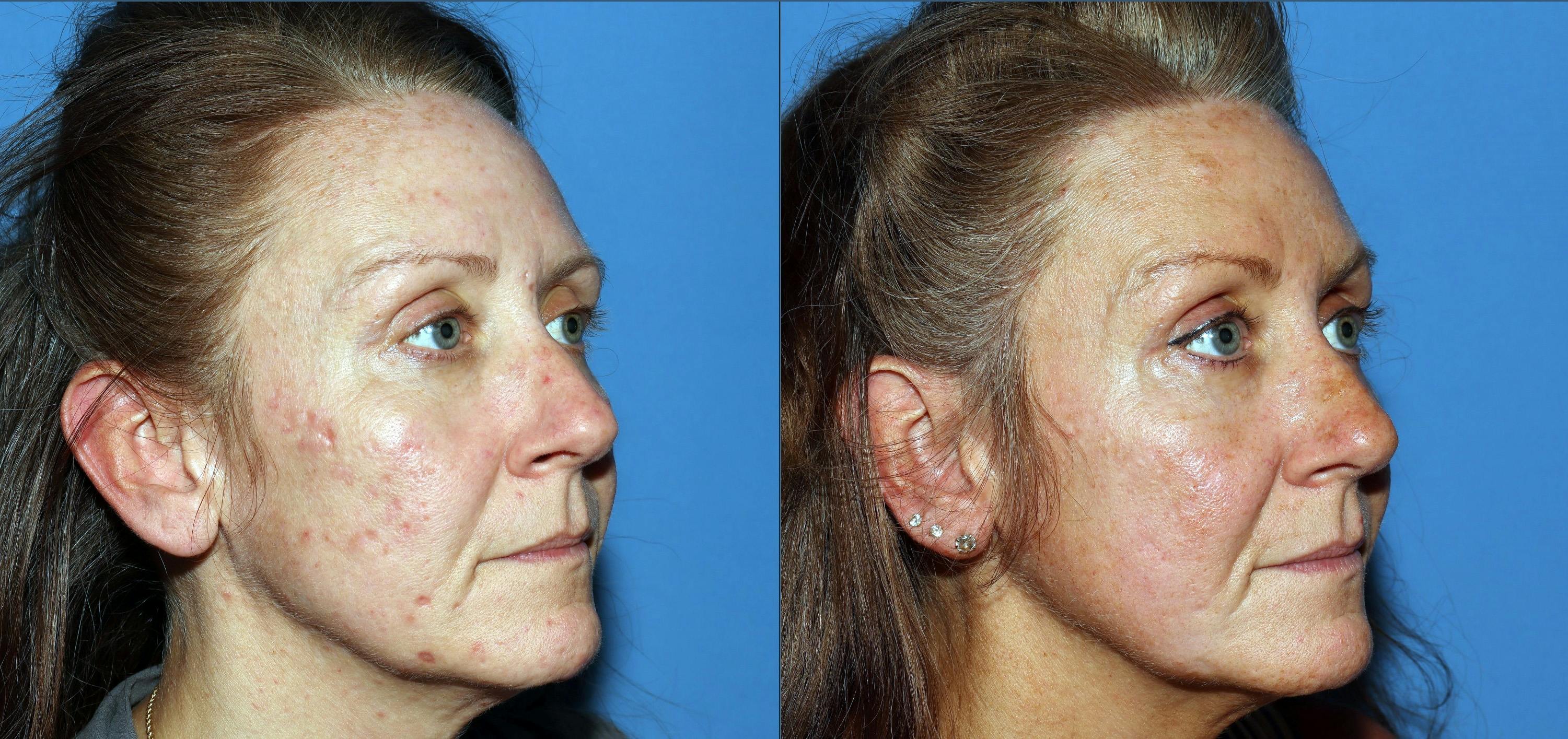 Contour TRL Laser Before & After Gallery - Patient 882108 - Image 2