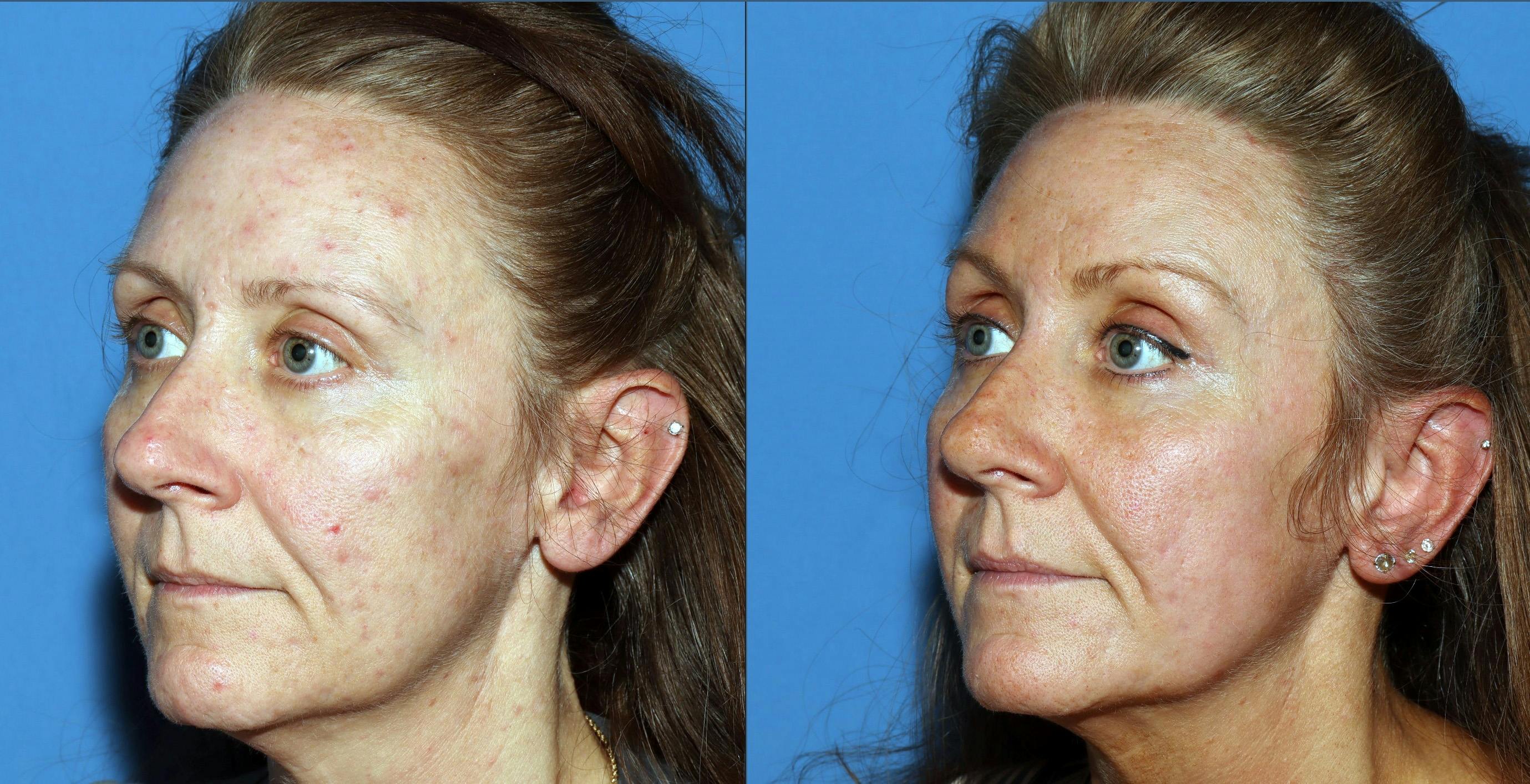 Contour TRL Laser Before & After Gallery - Patient 882108 - Image 4