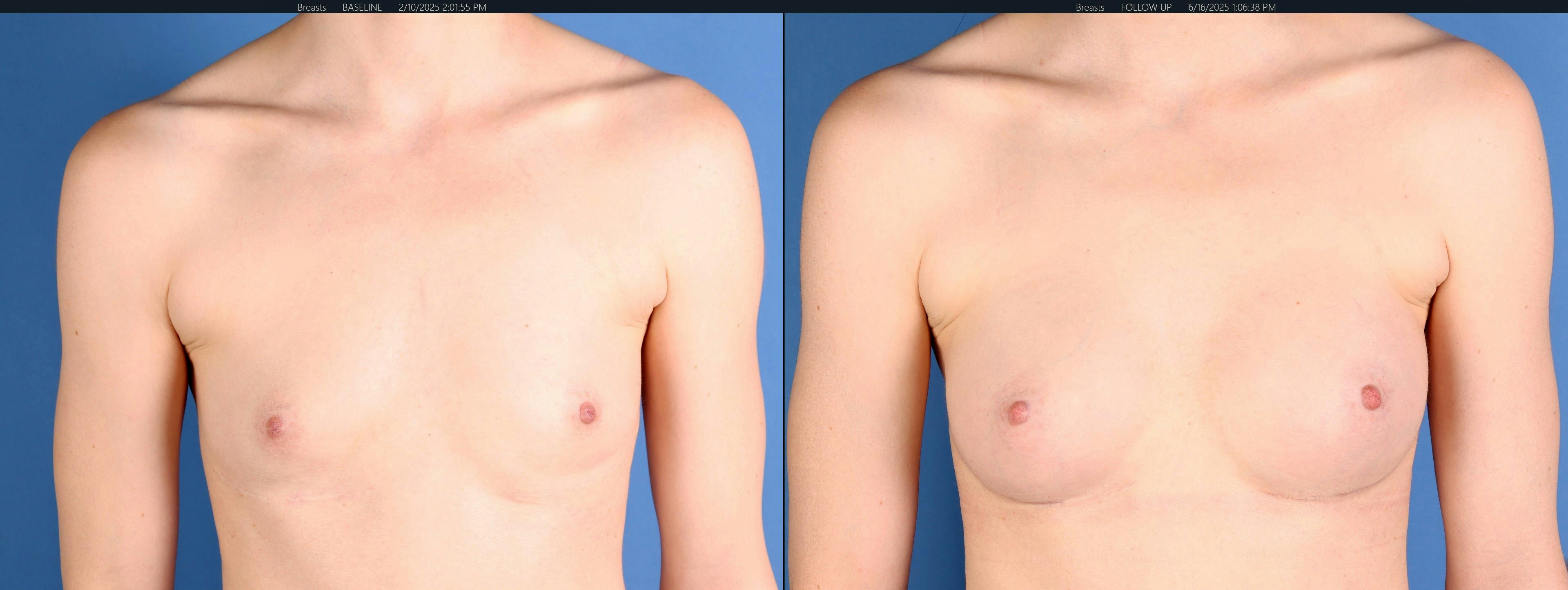 Breast Augmentation Before & After Gallery - Patient 272997 - Image 1