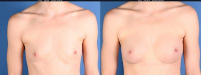 Breast Revision Before & After Gallery - Patient 284833 - Image 1