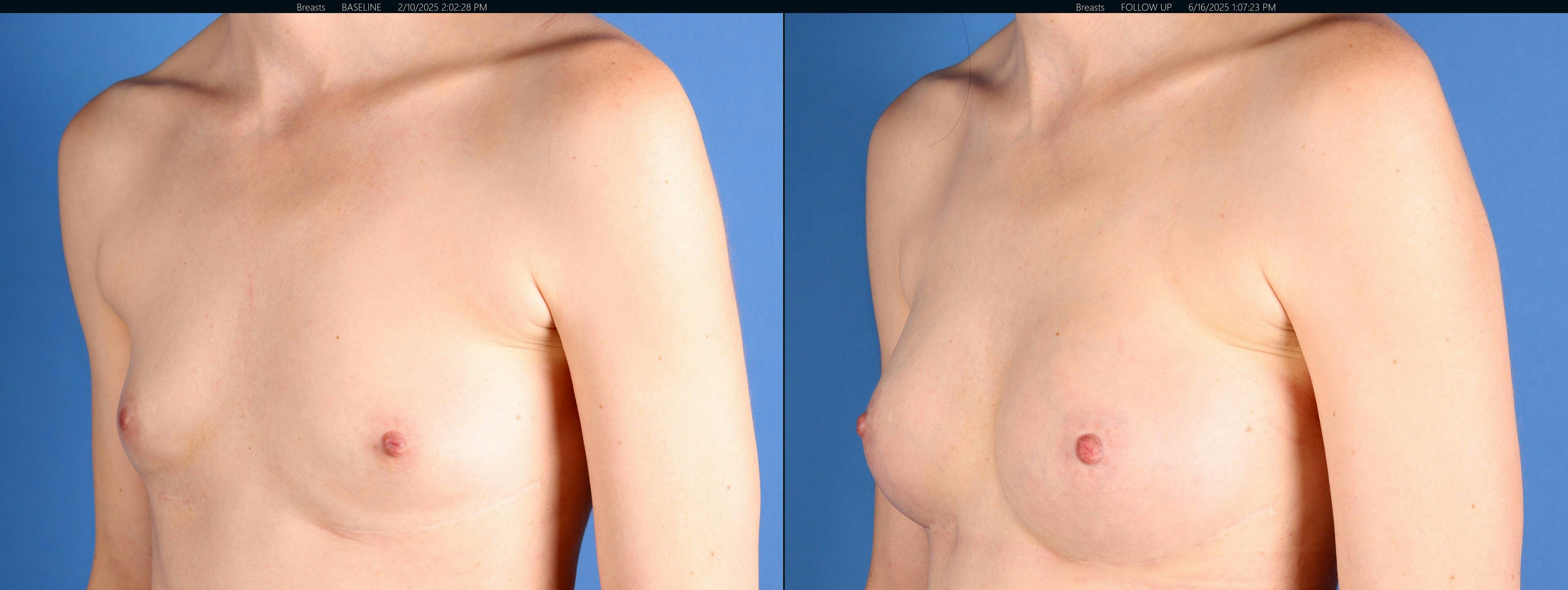 Breast Augmentation Before & After Gallery - Patient 272997 - Image 4