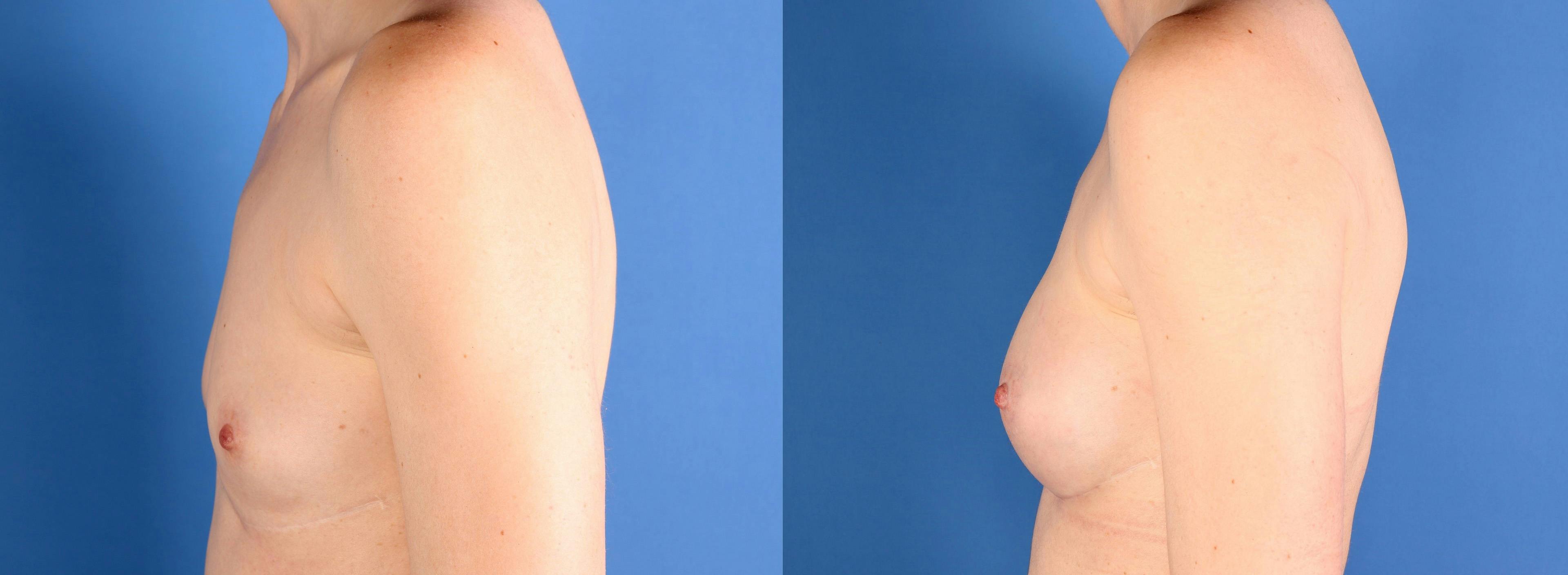 Breast Augmentation Before & After Gallery - Patient 272997 - Image 5