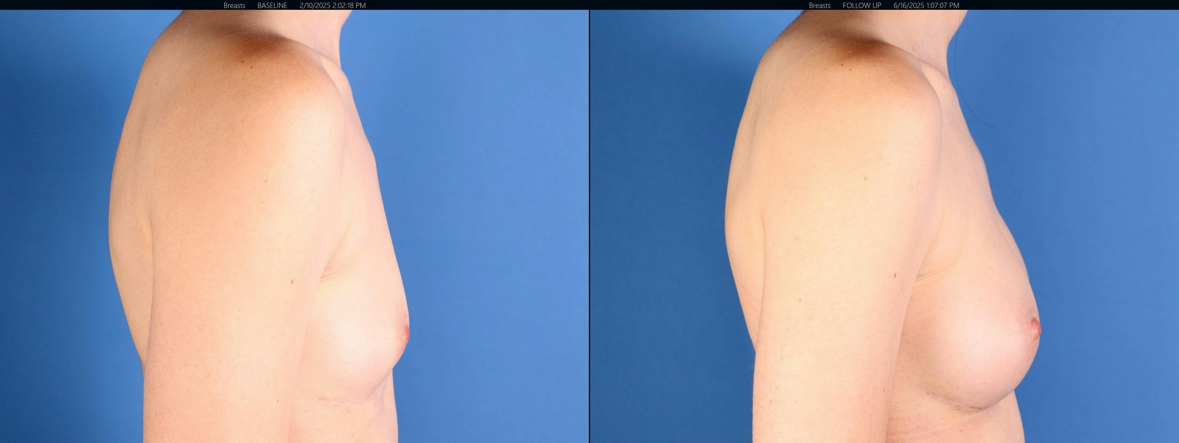 Breast Augmentation Before & After Gallery - Patient 272997 - Image 3