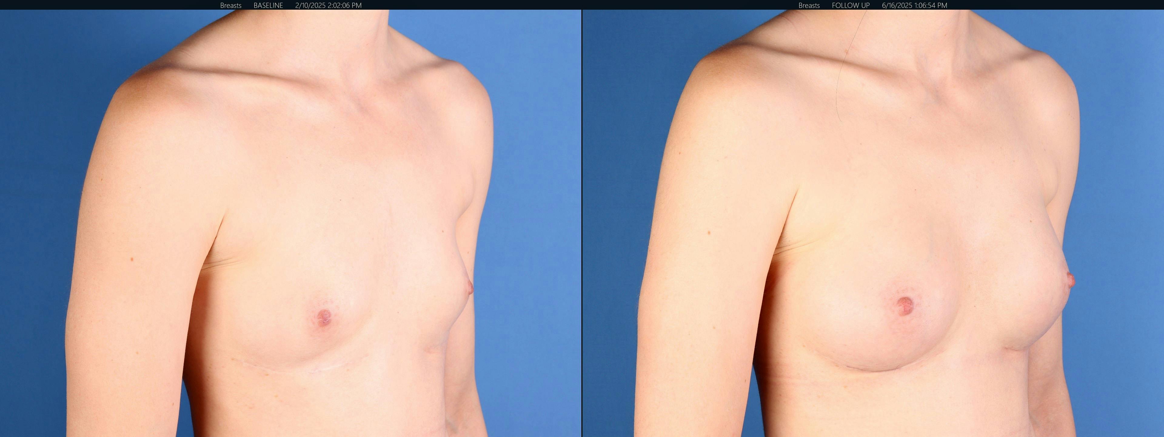 Breast Augmentation Before & After Gallery - Patient 272997 - Image 2
