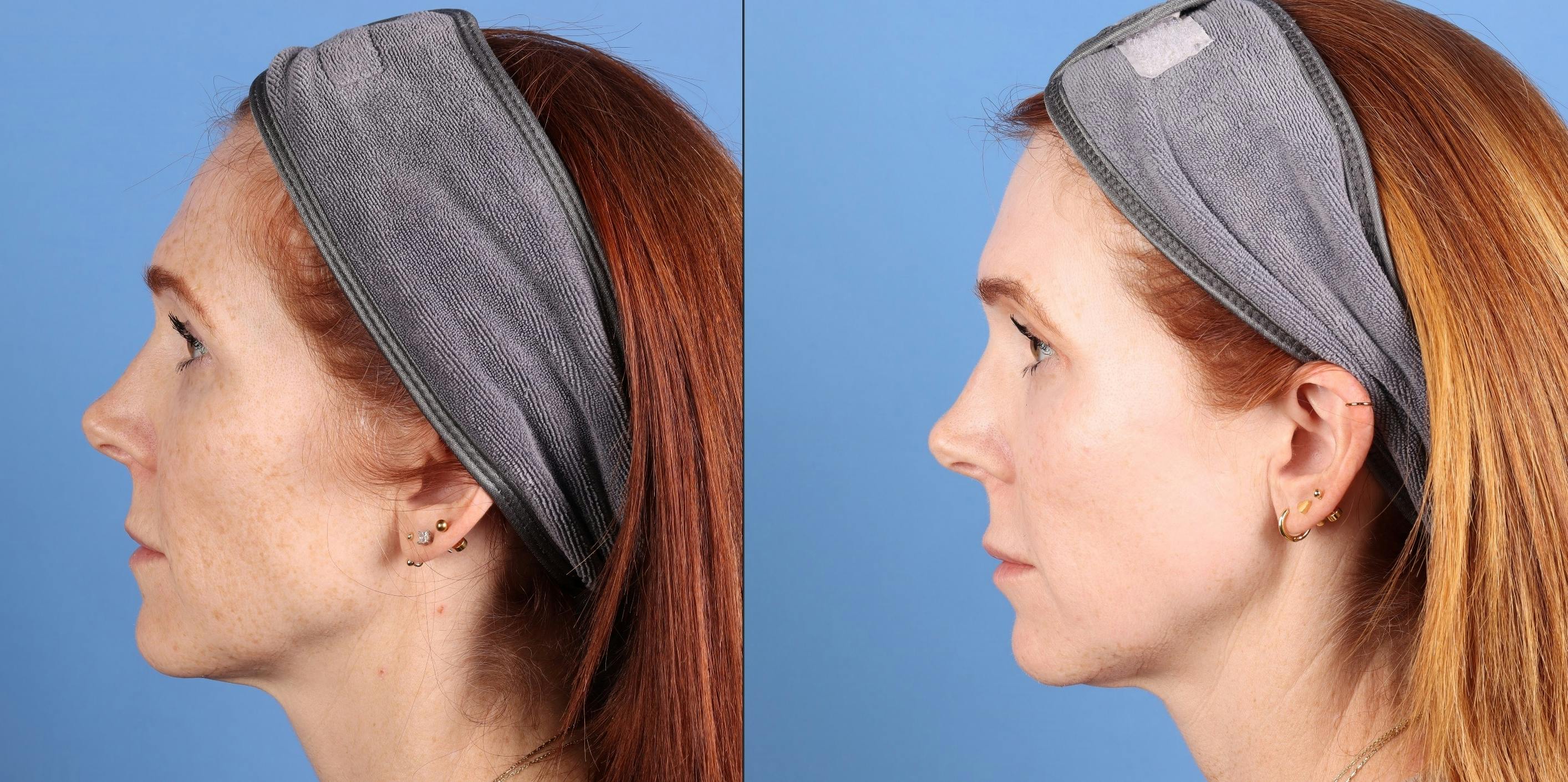 Contour TRL Laser Before & After Gallery - Patient 346308 - Image 5