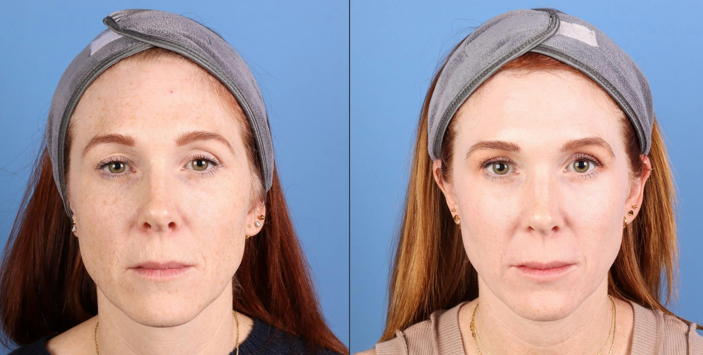 Contour TRL Laser Before & After Gallery - Patient 346308 - Image 2