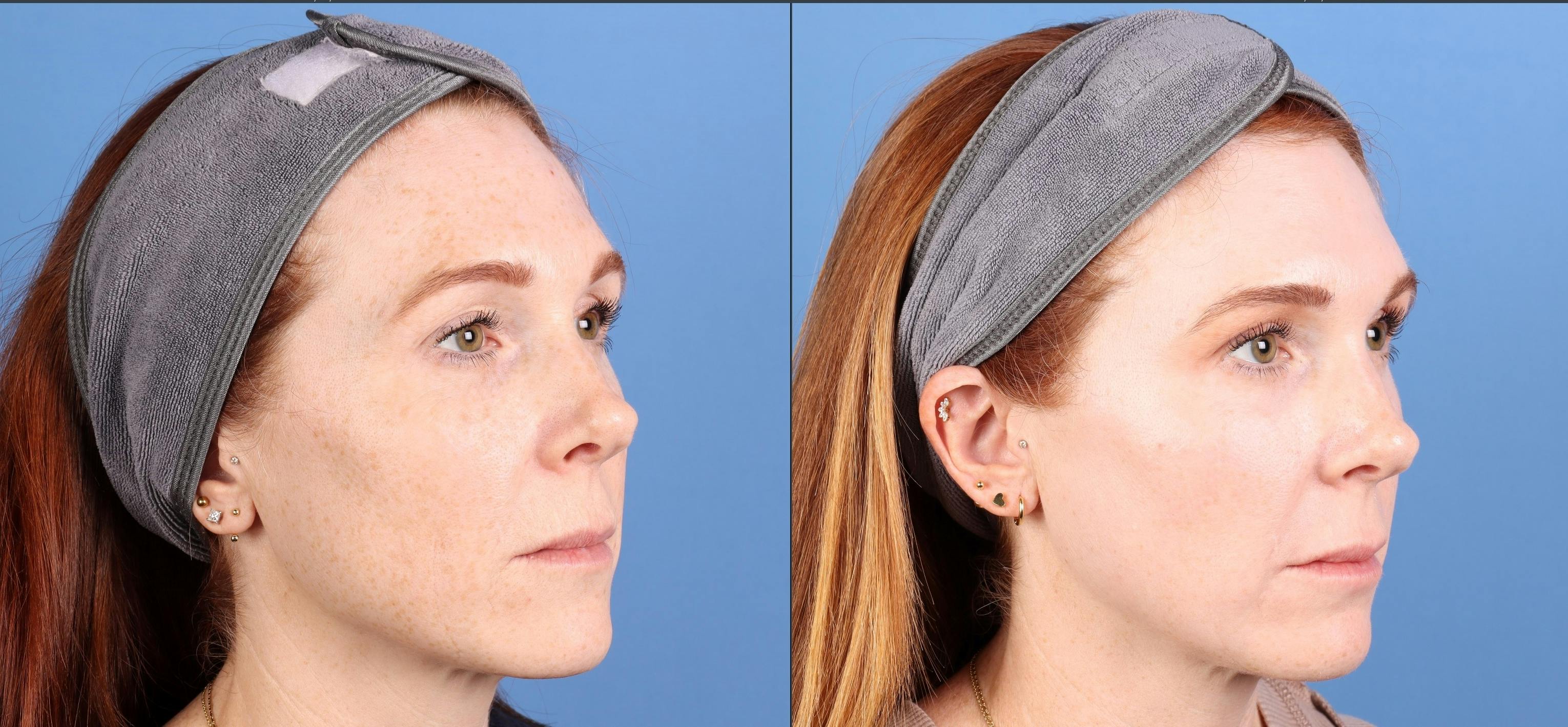 Contour TRL Laser Before & After Gallery - Patient 346308 - Image 3