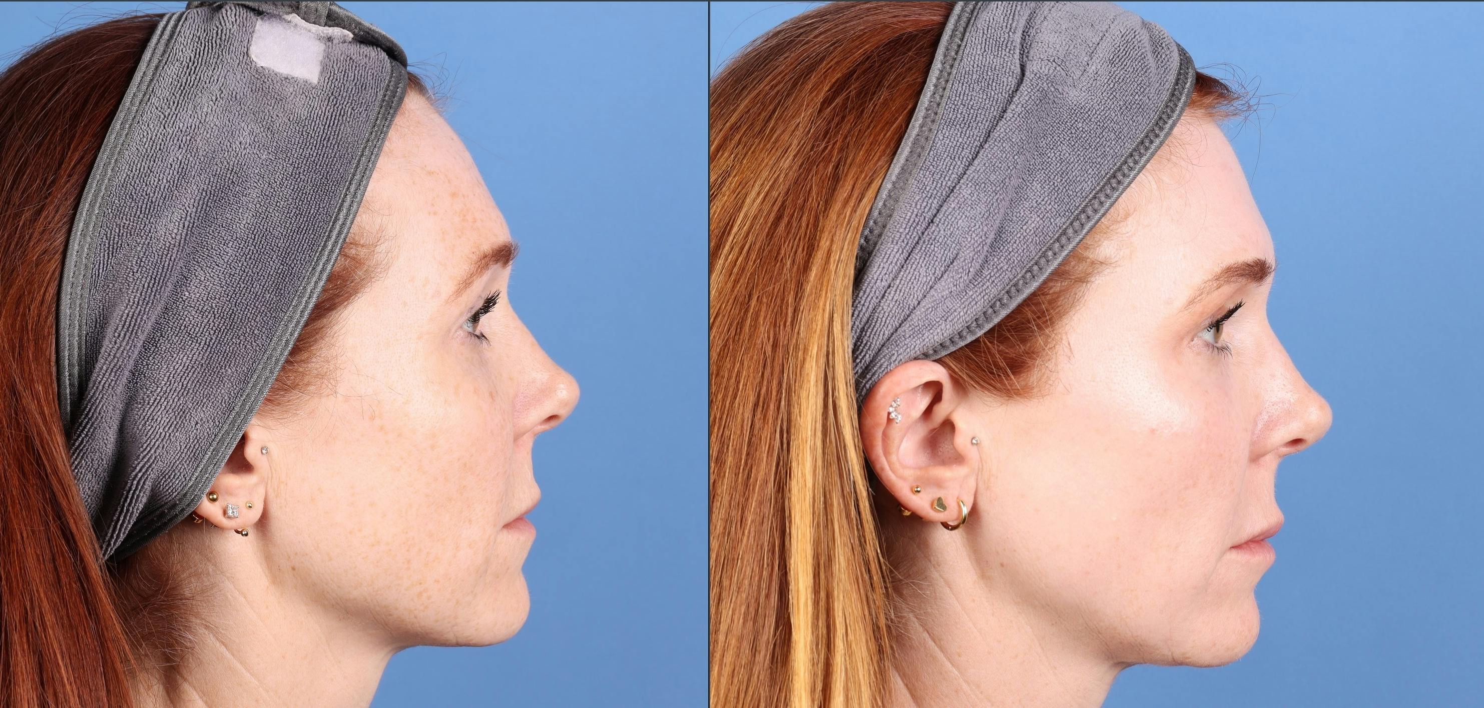 Contour TRL Laser Before & After Gallery - Patient 346308 - Image 4