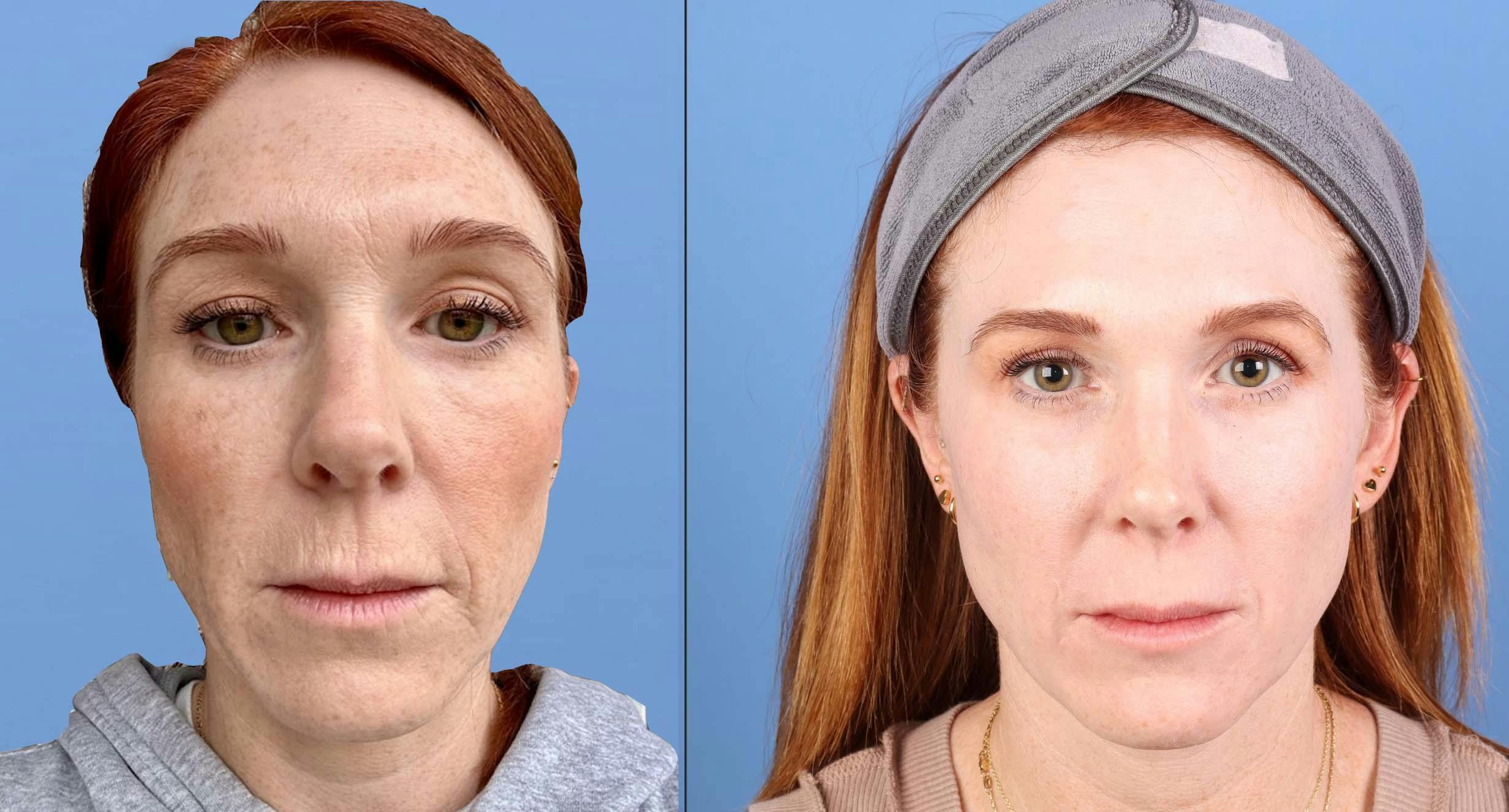 Contour TRL Laser Before & After Gallery - Patient 346308 - Image 1