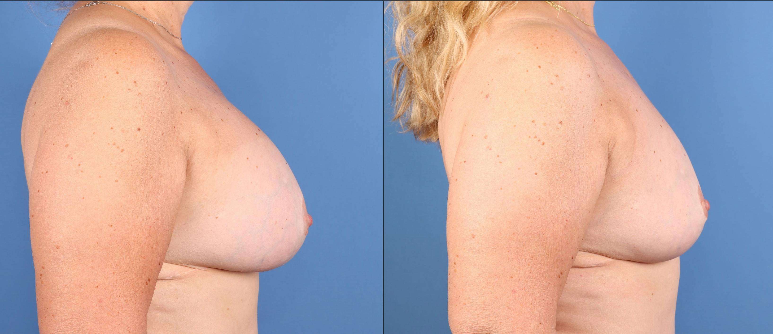 Breast Revision Before & After Gallery - Patient 269803 - Image 3