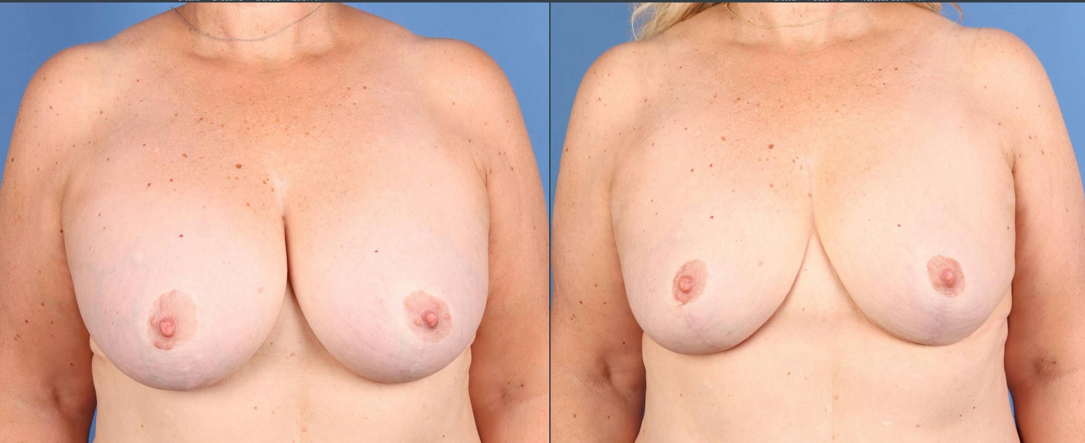 Breast Revision Before & After Gallery - Patient 425841 - Image 1