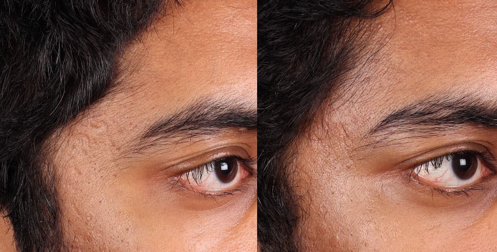 Acne Scar Treatment Before & After Gallery - Patient 195774 - Image 1