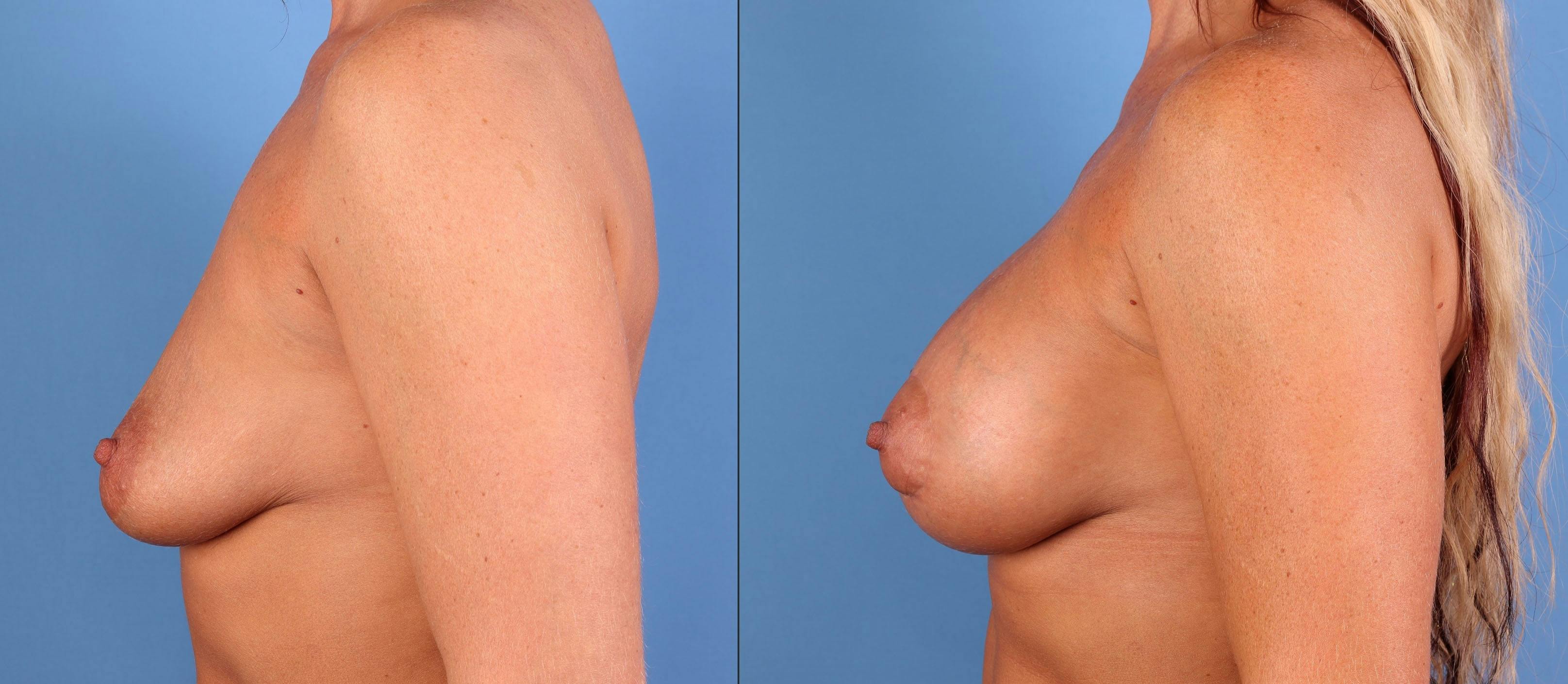 Breast Augmentation Before & After Gallery - Patient 384753 - Image 2