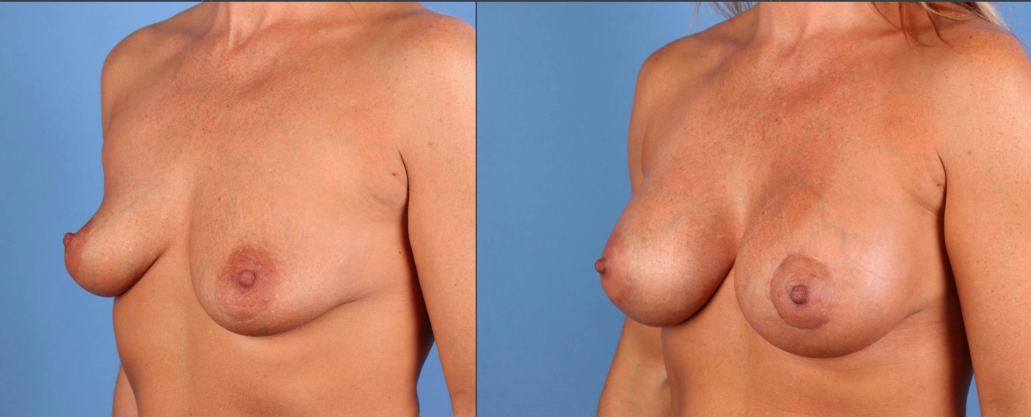 Breast Augmentation Before & After Gallery - Patient 384753 - Image 3