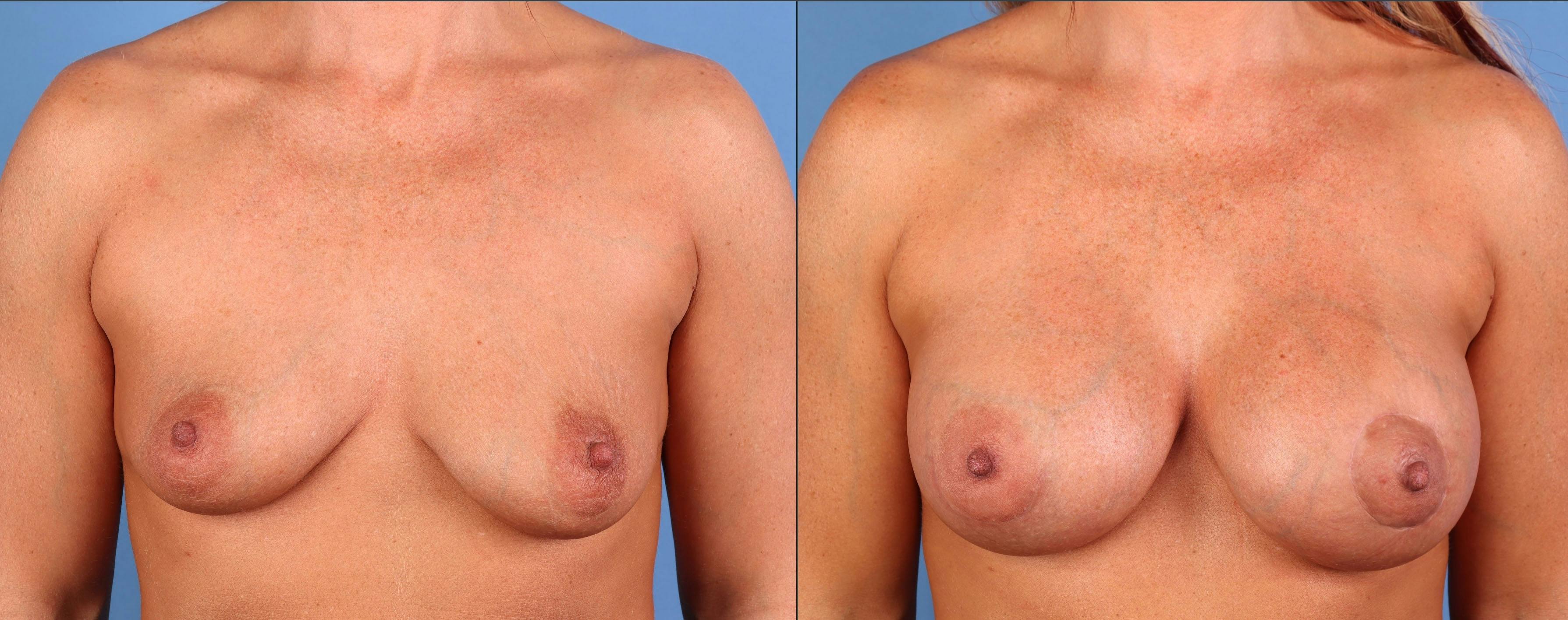 Breast Augmentation Before & After Gallery - Patient 384753 - Image 1