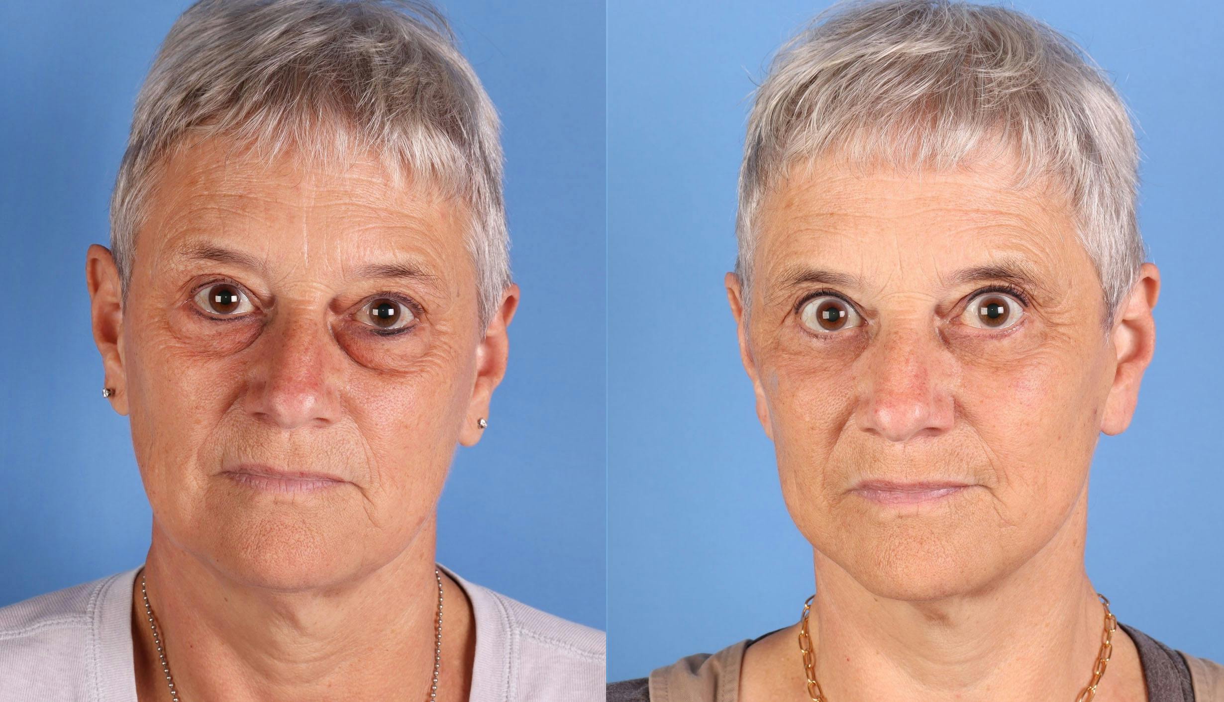 Eyelid Surgery (Upper & Lower Blepharoplasty) Before & After Gallery - Patient 599186 - Image 1