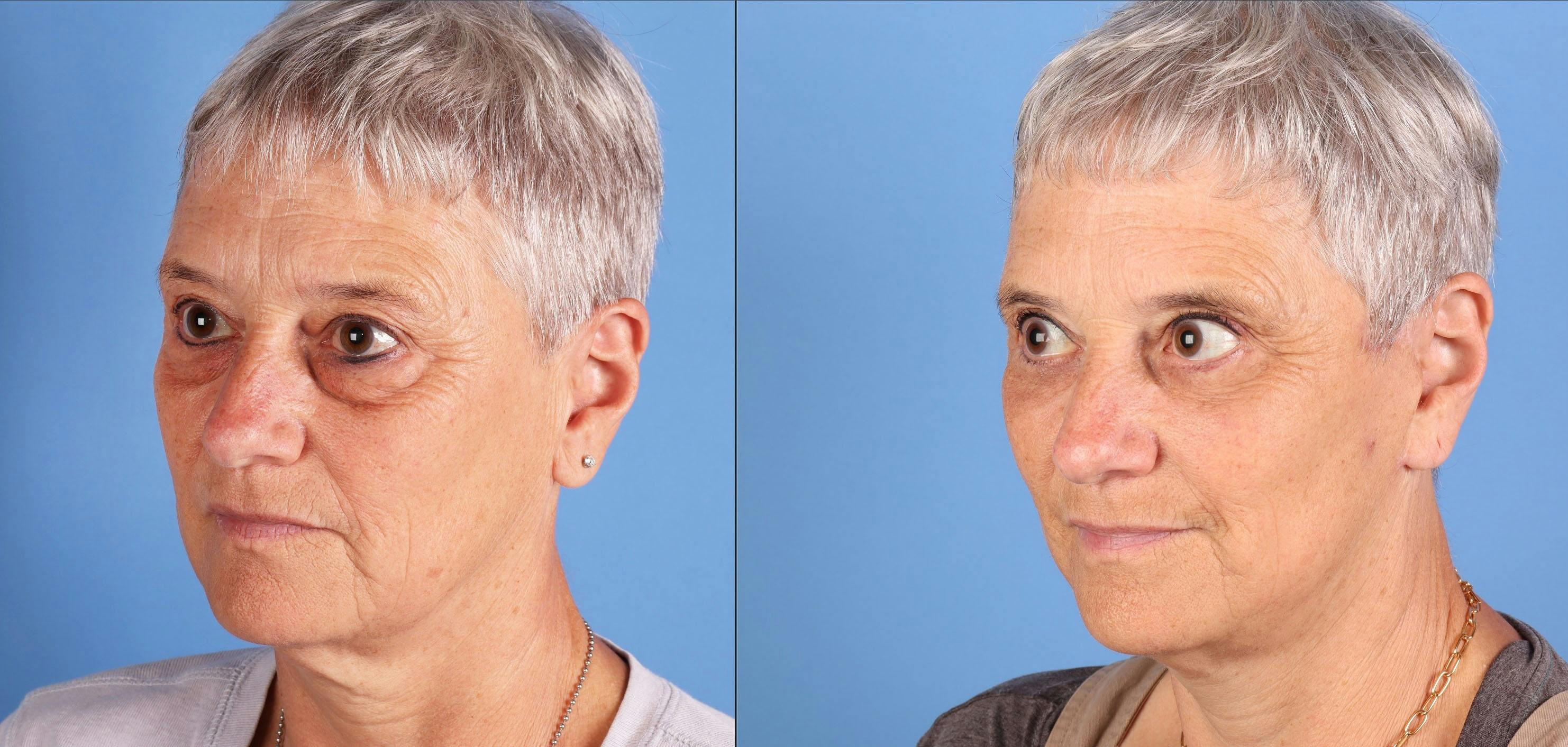 Eyelid Surgery (Upper & Lower Blepharoplasty) Before & After Gallery - Patient 599186 - Image 2