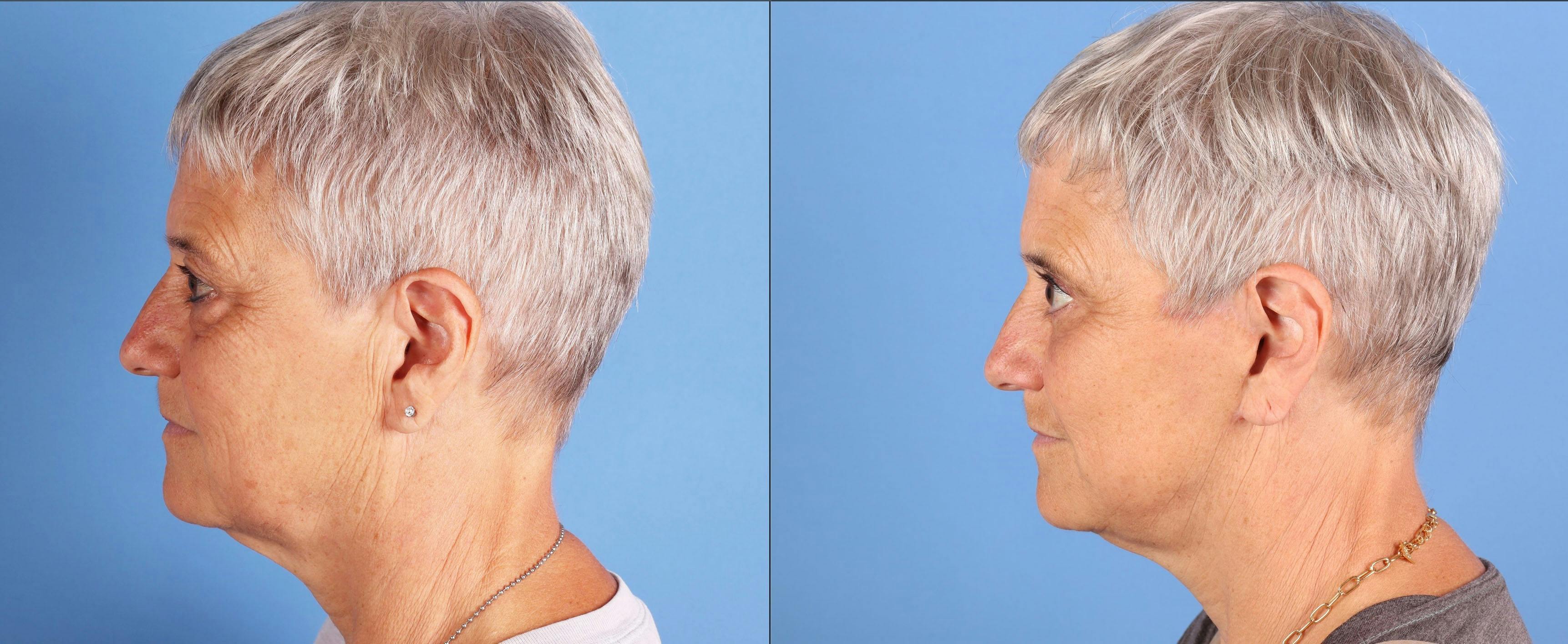 Eyelid Surgery (Upper & Lower Blepharoplasty) Before & After Gallery - Patient 599186 - Image 3