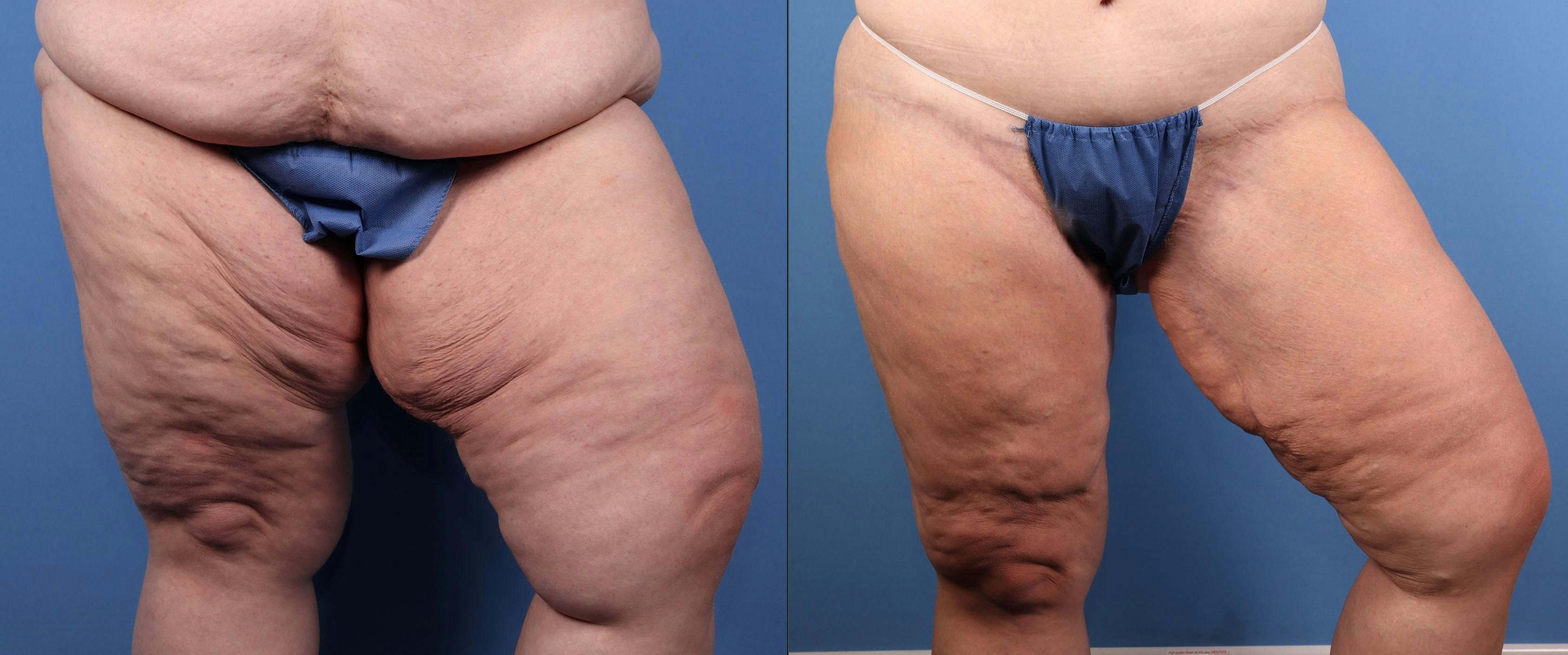 Thigh Lift Before & After Gallery - Patient 194953 - Image 2