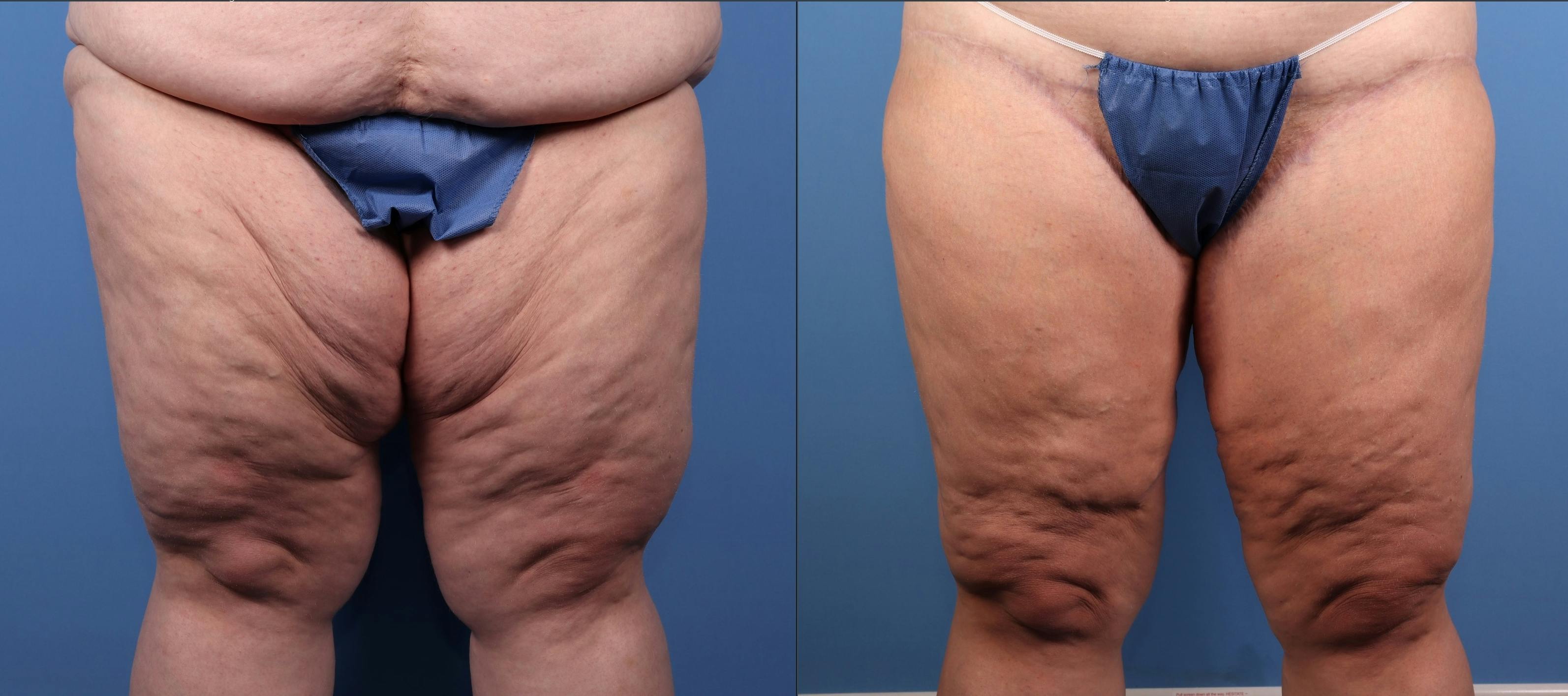 Thigh Lift Before & After Gallery - Patient 194953 - Image 1